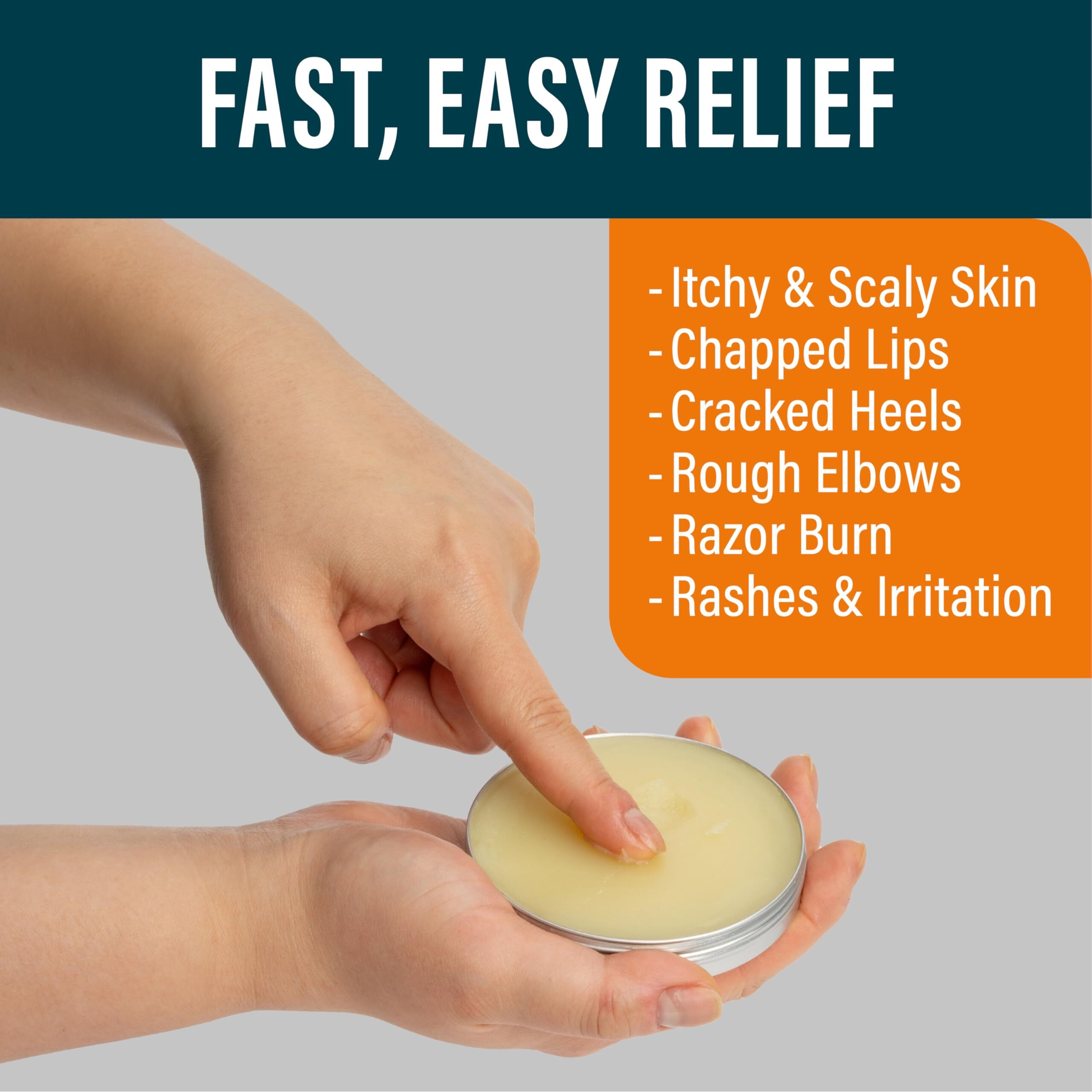 Nuvadermis Tea Tree Oil Foot Balm - Effective Recovery Balm For Dry, Cracked Feet, Athletes Foot, Ringworm & Itchy Skin - Soothing Moisturizer - 2 Oz