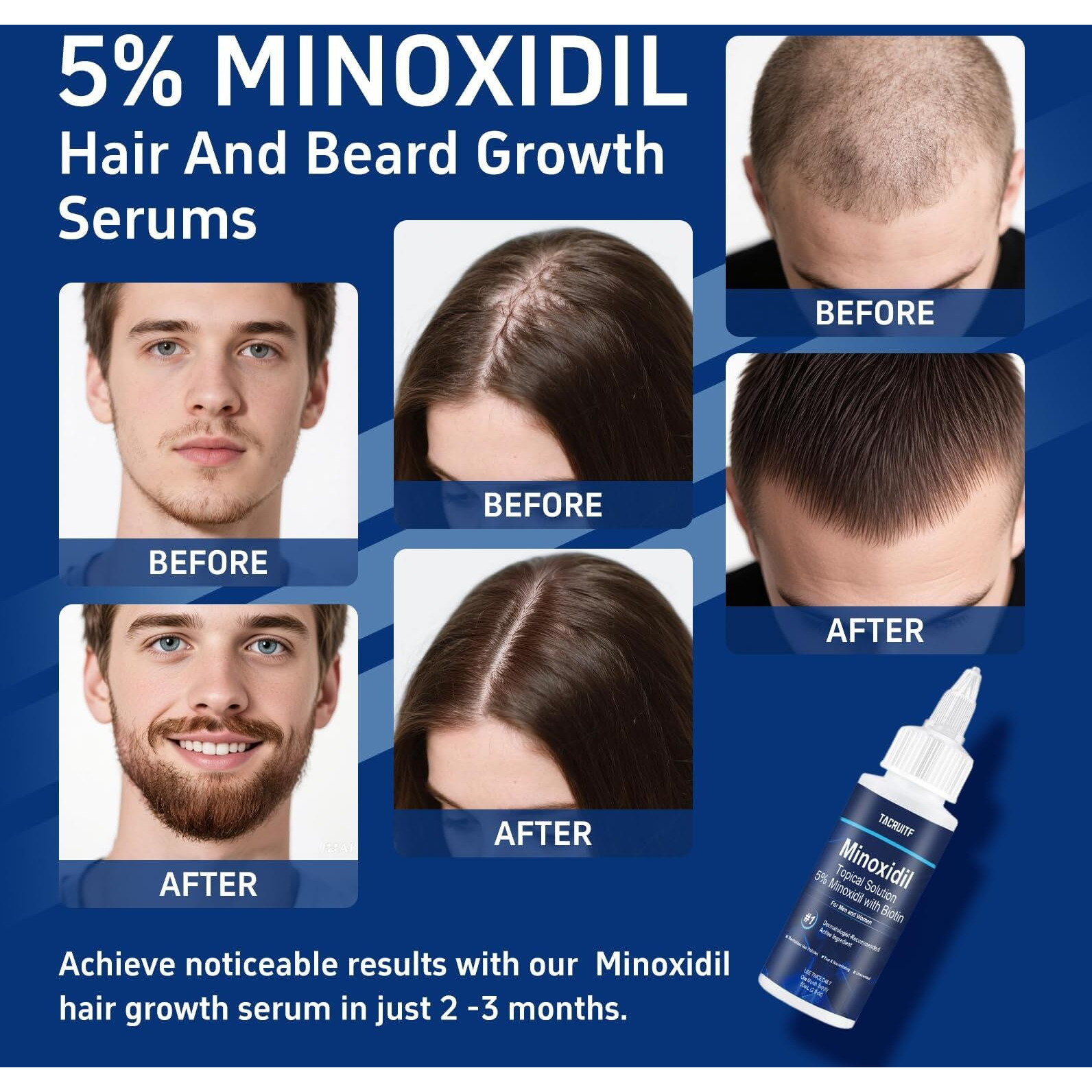 6 Packs, 5% Minoxidil With Biotin, Hair Growth Treatment, Minoxidil Hair And Beard Growth Oil, Minoxidil For Men And Women, Supports Thicker And Fuller Hair & Beard (12 Fl Oz, 6 Month Supply)