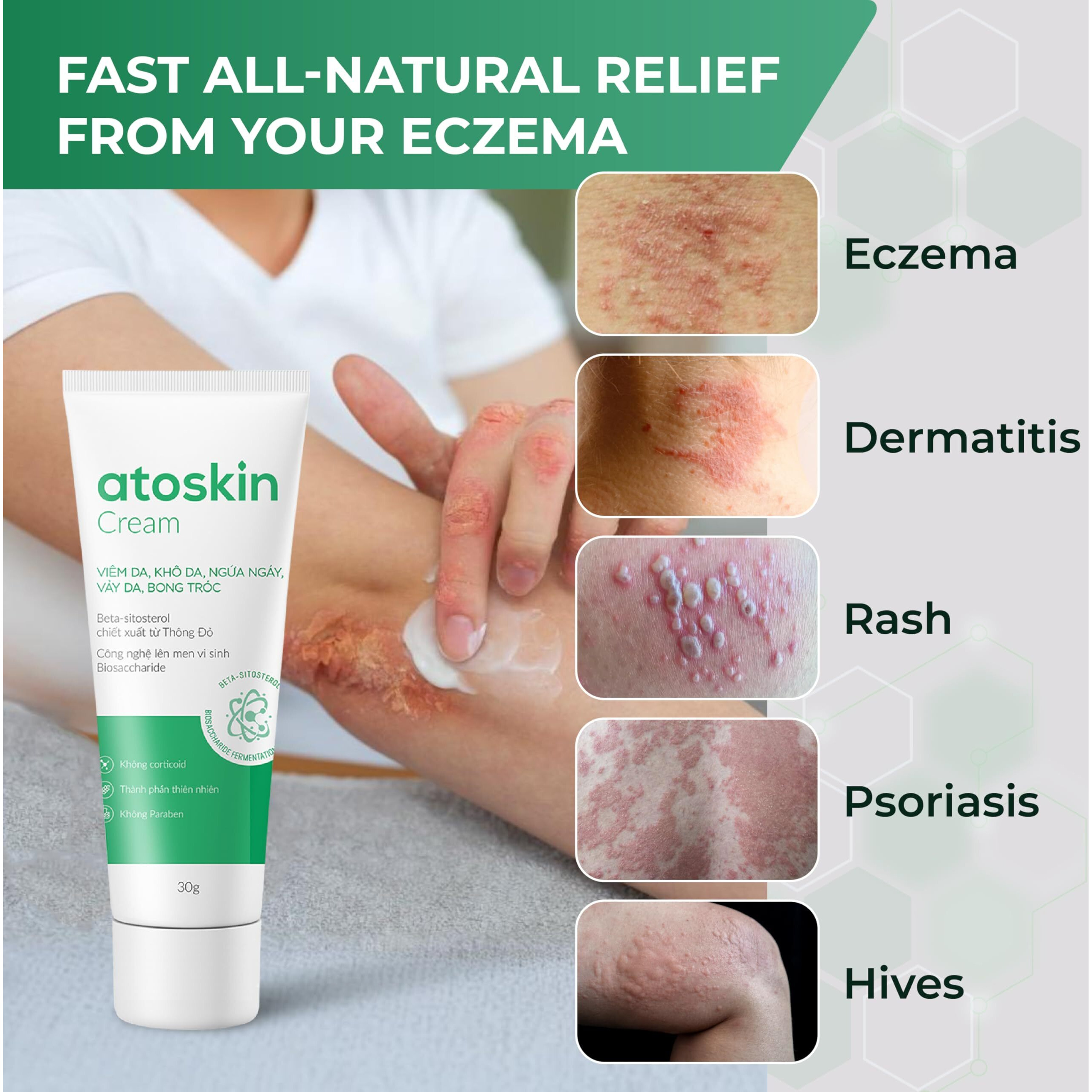 Atoskin Eczema Cream, Psoriasis & Folliculitis Soothing Lotion, For Drying, Itching And Dermatitis Irritation, Gentle Moisturizer For Adults & Kids With Shea Butter & Sweet Almond Oil (1.01 Oz)