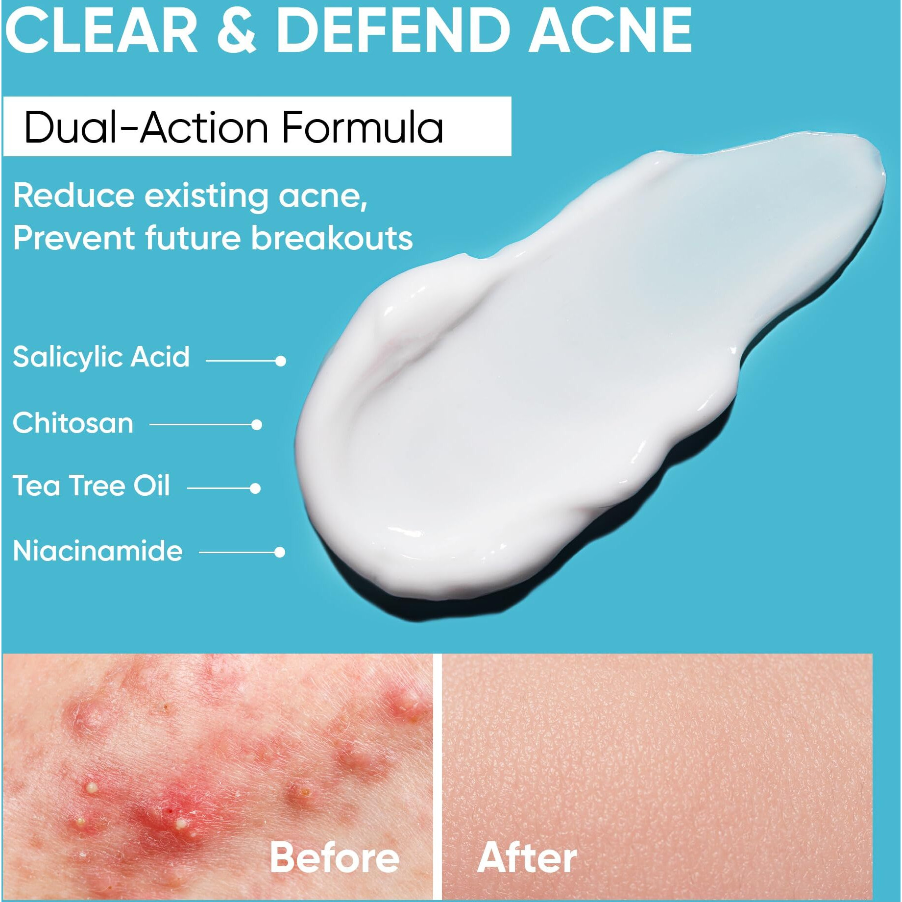 Butt Acne Clearing Treatment Cream Clears & Prevents Breakouts Fast - Gentle Body & Back Lotion For Clogged Pores, Folliculitis & Bumps, 2% Salicylic Acid & Niacinamide, Ideal For Women, Men & Teens