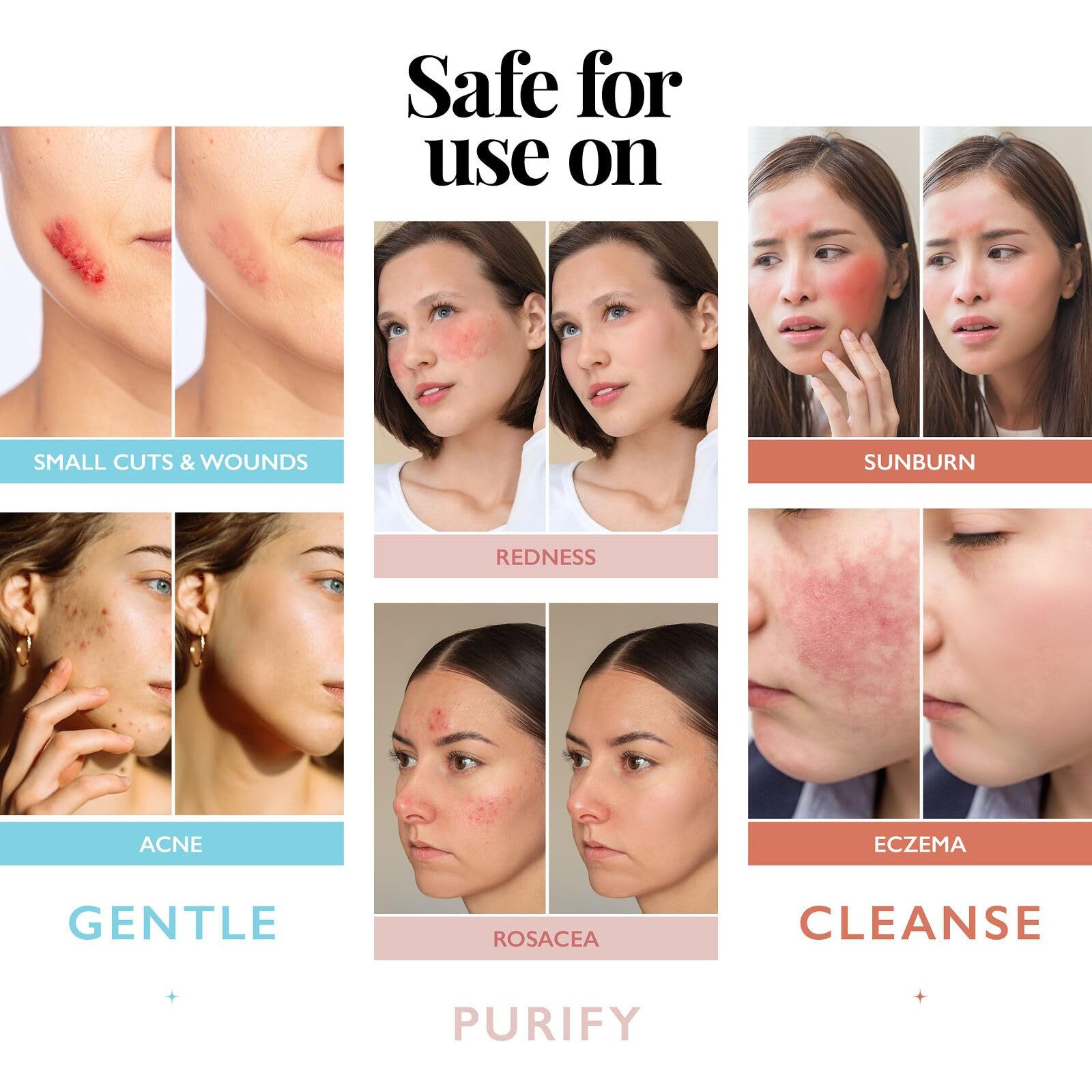 Hypochlorous Acid Spray For Face And Skin | Piercing Aftercare Spray | 8 Oz Hypochlorous Acid Sprays For Face, Skin, Acne, Eczema, Body Acne Sprays, Piercing Aftercare, Facial Wound Solution, Workout