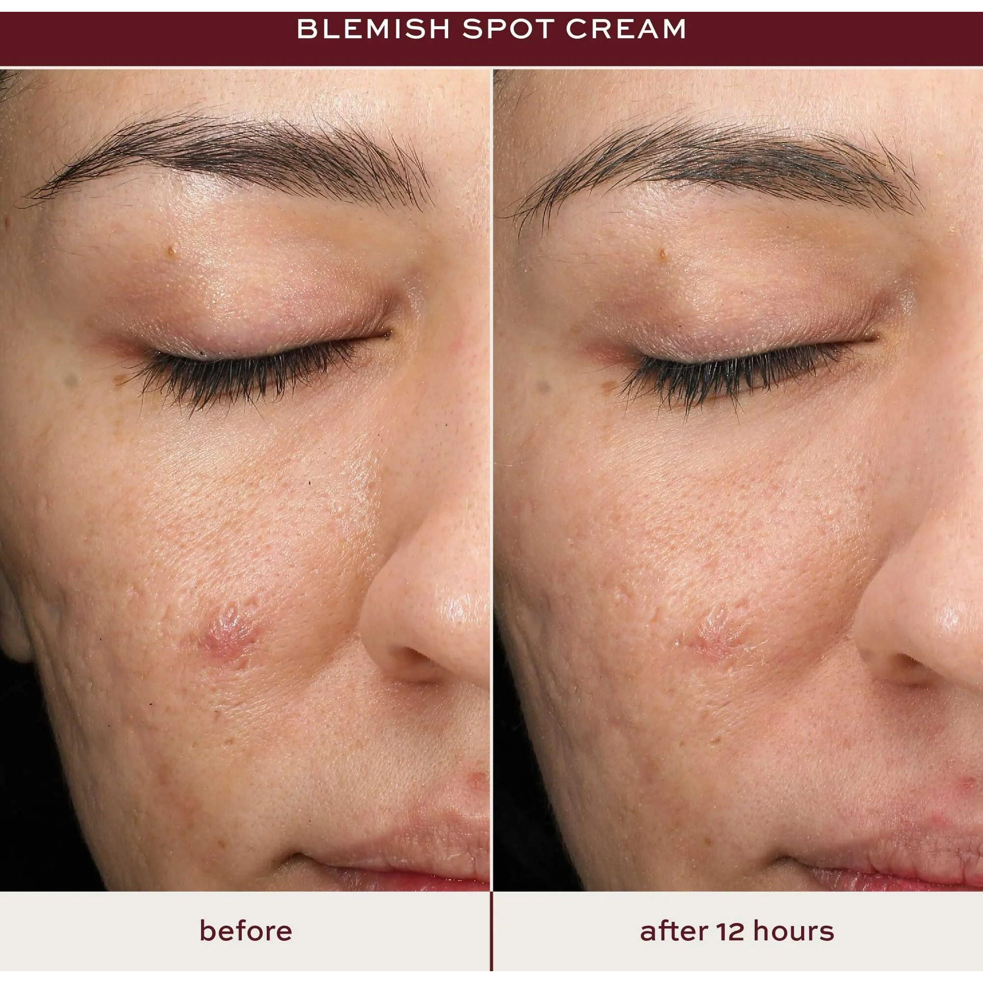 Itk Skincare Salicylic Acid Acne Spot Treatment For Face, Back & Body - Fast Active Acne Relief - Pimple Cream For Acne Prone Skin - Clear Blemishes Fast With Tea Tree Oil - 0.5Oz