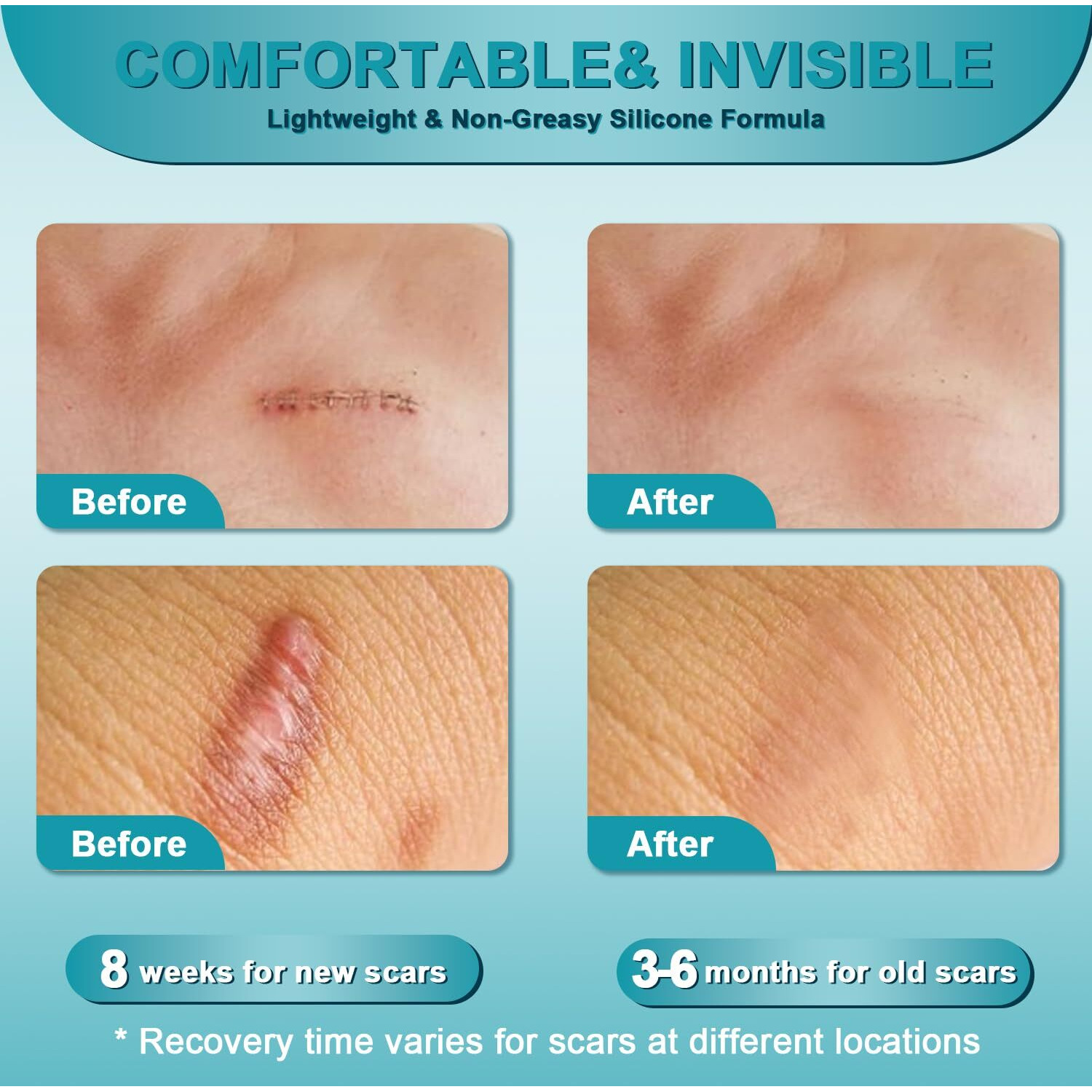 Scar Cream, Advanced Scar Gel For Old & New Scars, Professional Scar Removal Cream For Surgical Scars, Face, Body, Leg, Acne, Stitches, Burns, C-Section, Keloids, 1.76Oz