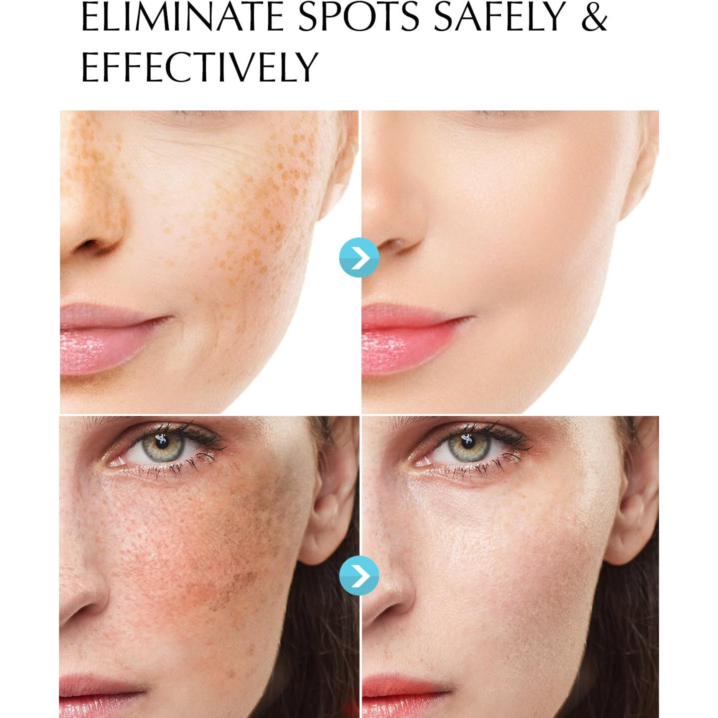 Dark Spot Remover For Face And Body Hyperpigmentation Treatment - Natural Ingredient - Freckle/Melasma/Sun Spot/Age Spot Remover - Dark Spot Corrector Cream For Women And Men