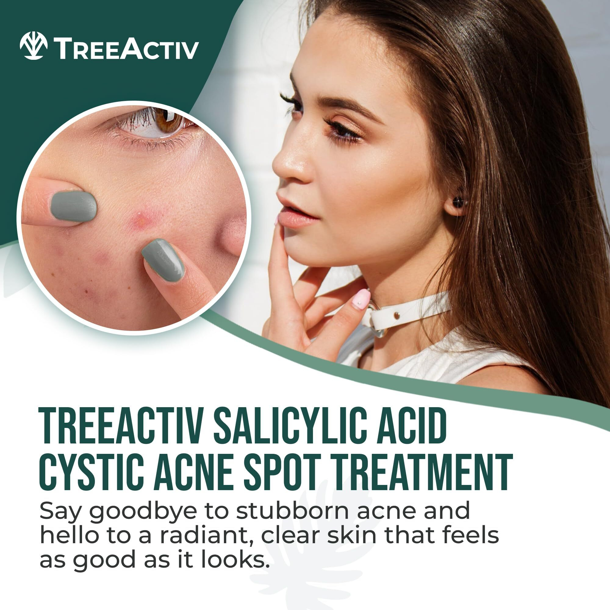 Treeactiv Salicylic Acid Cystic Acne Spot Treatment, 0.5 Fl Oz, For Face And Body, Cream For Hormonal Acne, Teens & Adults