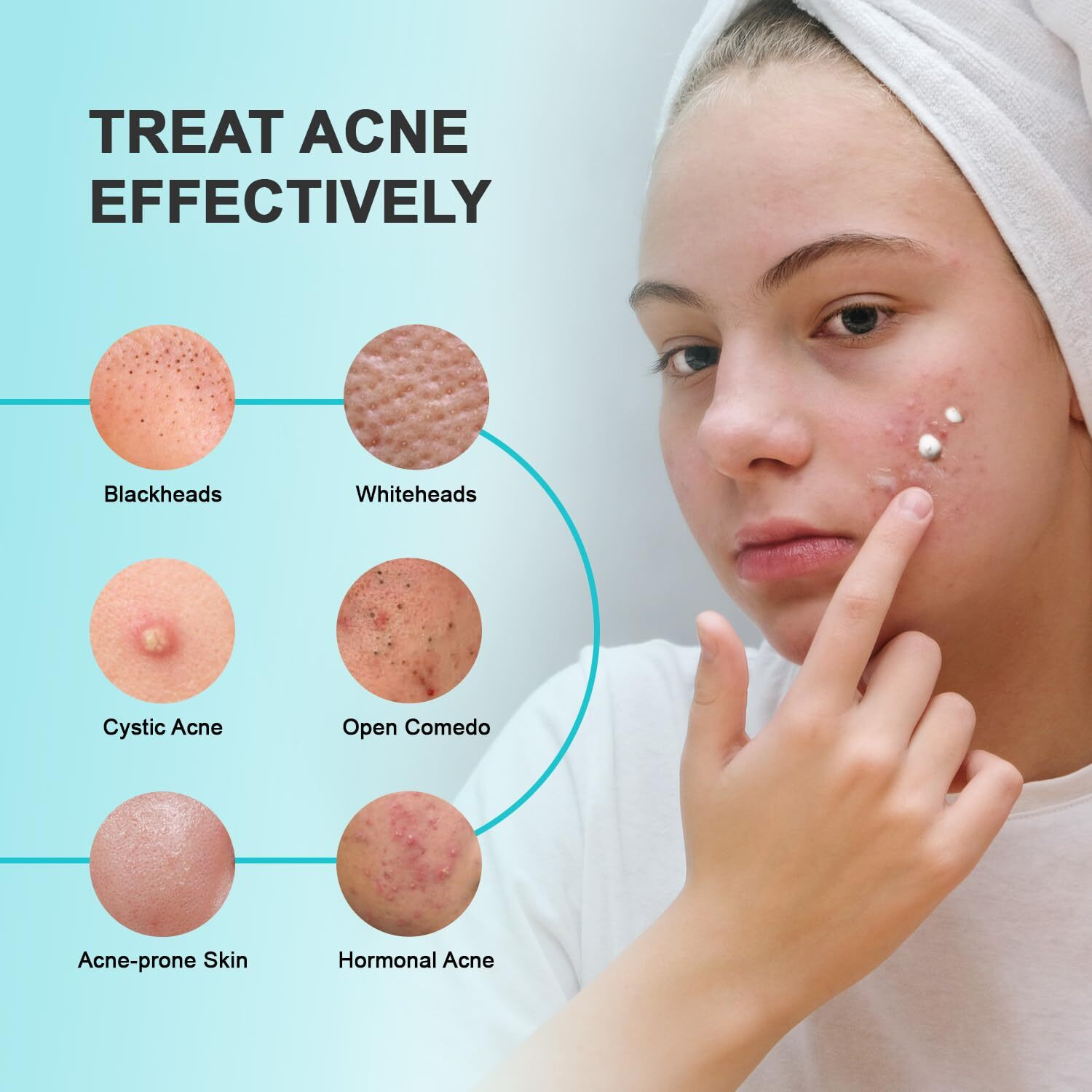 Acne Pimple Spot Treatment Cream Cystic Hormonal Blackheads Blemish Breakouts For Face, Back And Body - 10% Azelaic Acid & Salicylic Acid - Teens-Adults, 1.8 Oz