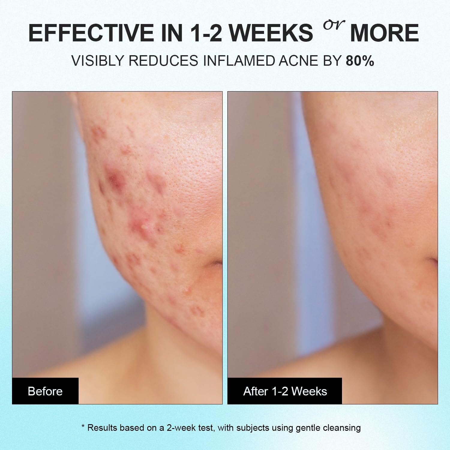 Acne Pimple Spot Treatment Cream Cystic Hormonal Blackheads Blemish Breakouts For Face, Back And Body - 10% Azelaic Acid & Salicylic Acid - Teens-Adults, 1.8 Oz