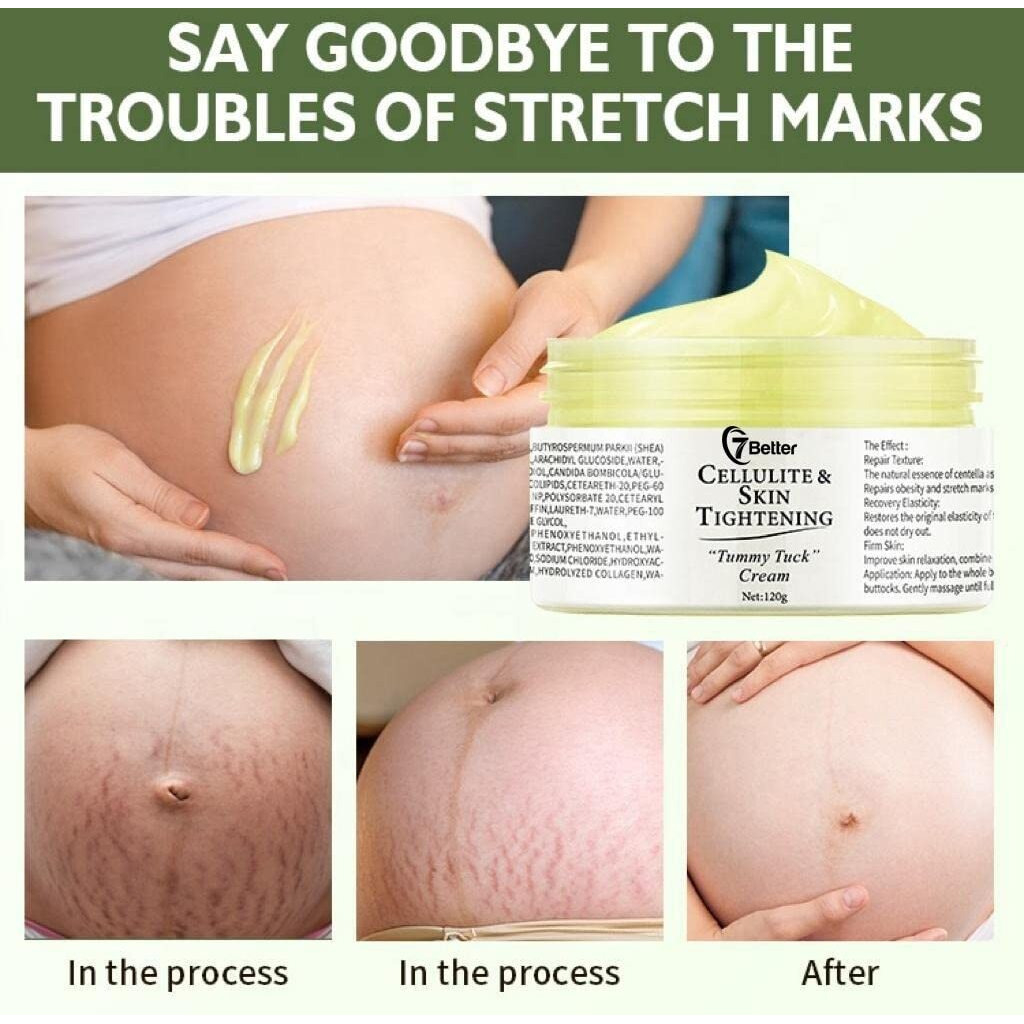 Stretch Marks And Scars Removal Cream For Pregnancy - Scars Repair, Abdominal Firming, And Gentle Stretch Marks Eradication Skincare Body