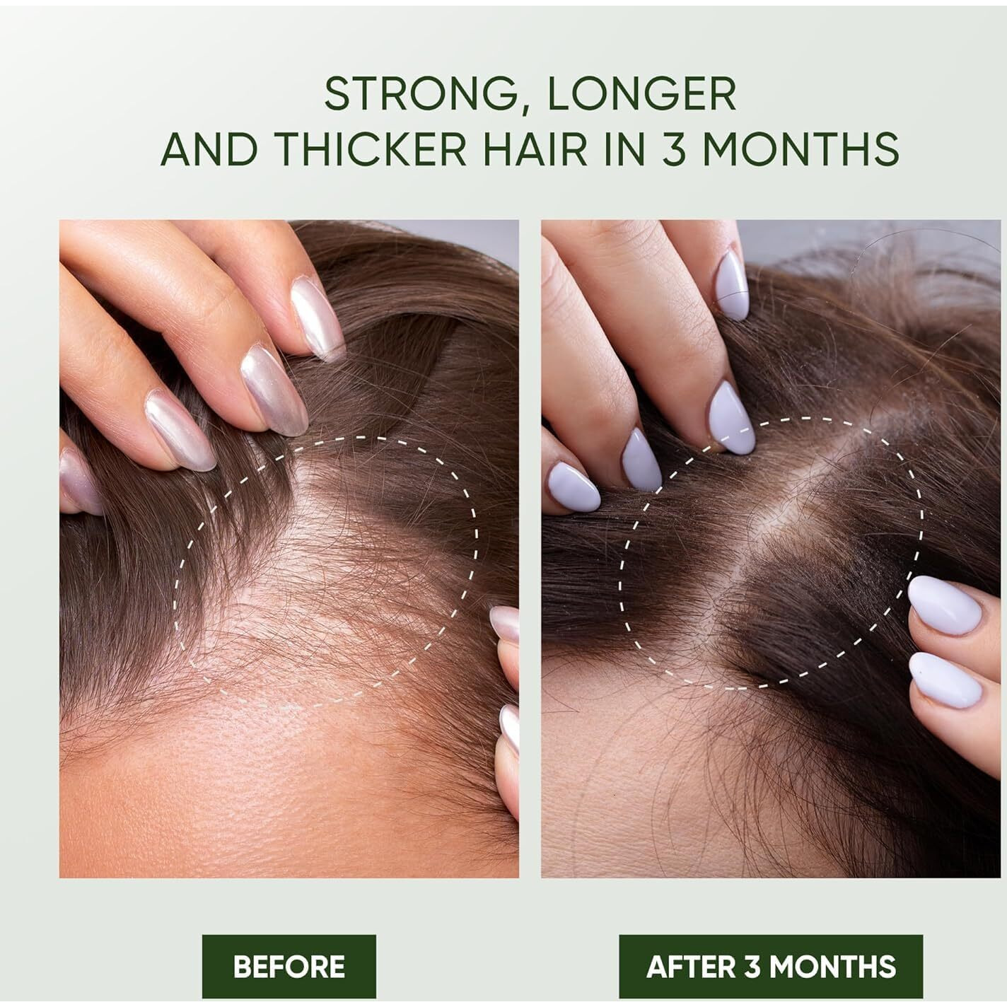 Svvimer Rosemary Hair Growth Shampoo - Thickening Shampoo With Biotin Tea Tree Oil Mint For Hair Loss And Thinning Hair - For Women And Men 11.8 Fl Oz (Pack Of 1)