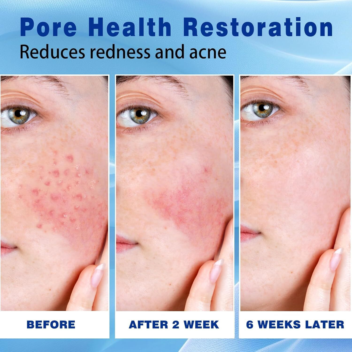 2-Pack 10% Azelaic Acid Acne Cream, Premium Azelaic Acid Facial Cream - Redness Relief For Face, Redness Reducing Skin Care, Prevents Acne Breakouts, Ease Pimple Clarify Skin Soothe Irritation,1 Oz