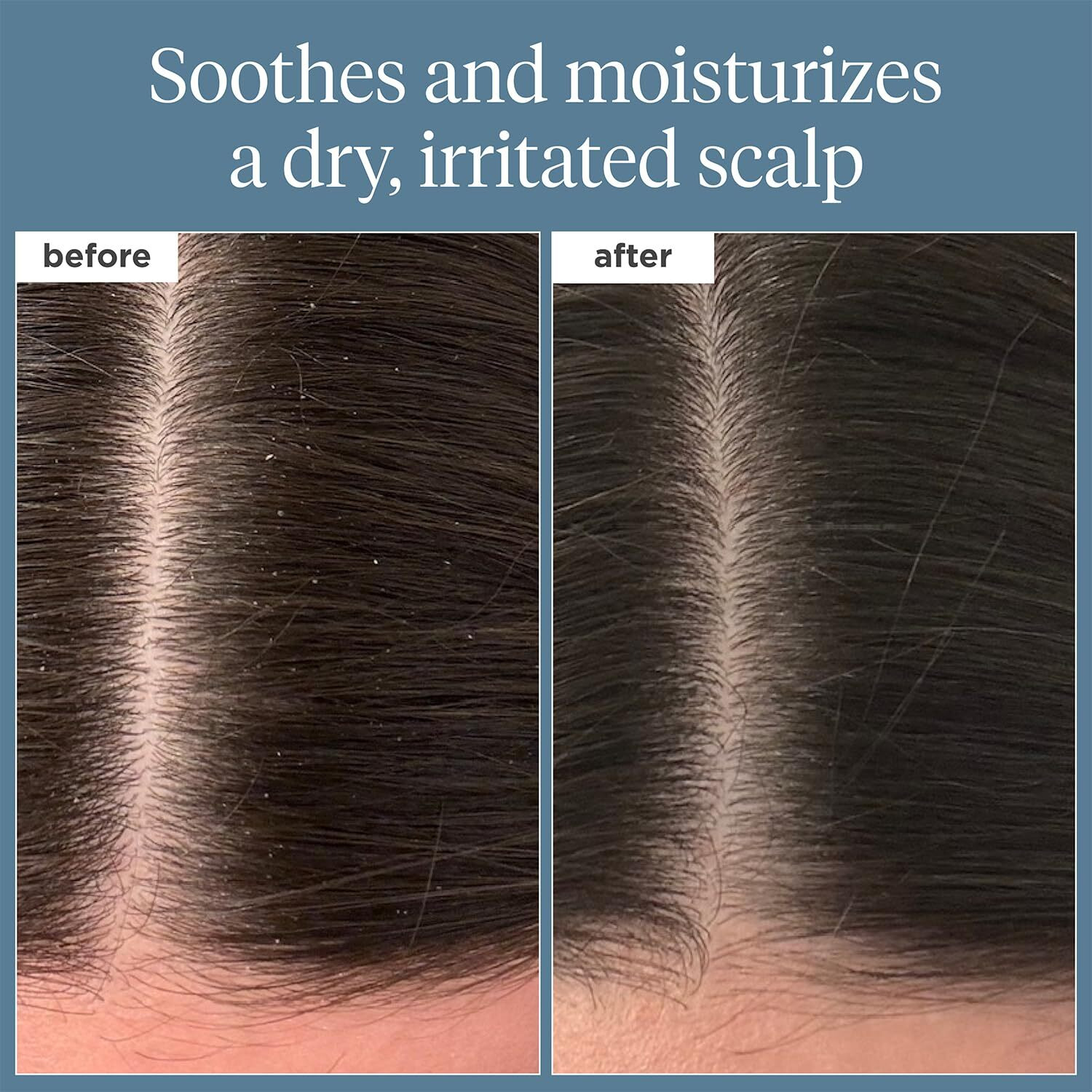 Briogeo Scalp Revival Rosemary Pre-Wash Oil, Hair And Scalp, Dry Scalp Treatment For Stronger And Longer Hair, Soothe Dry Scalp, Lipids And Vitamins, Deep Moisture, Vegan, Cruelty-Free, 1 Fl Oz