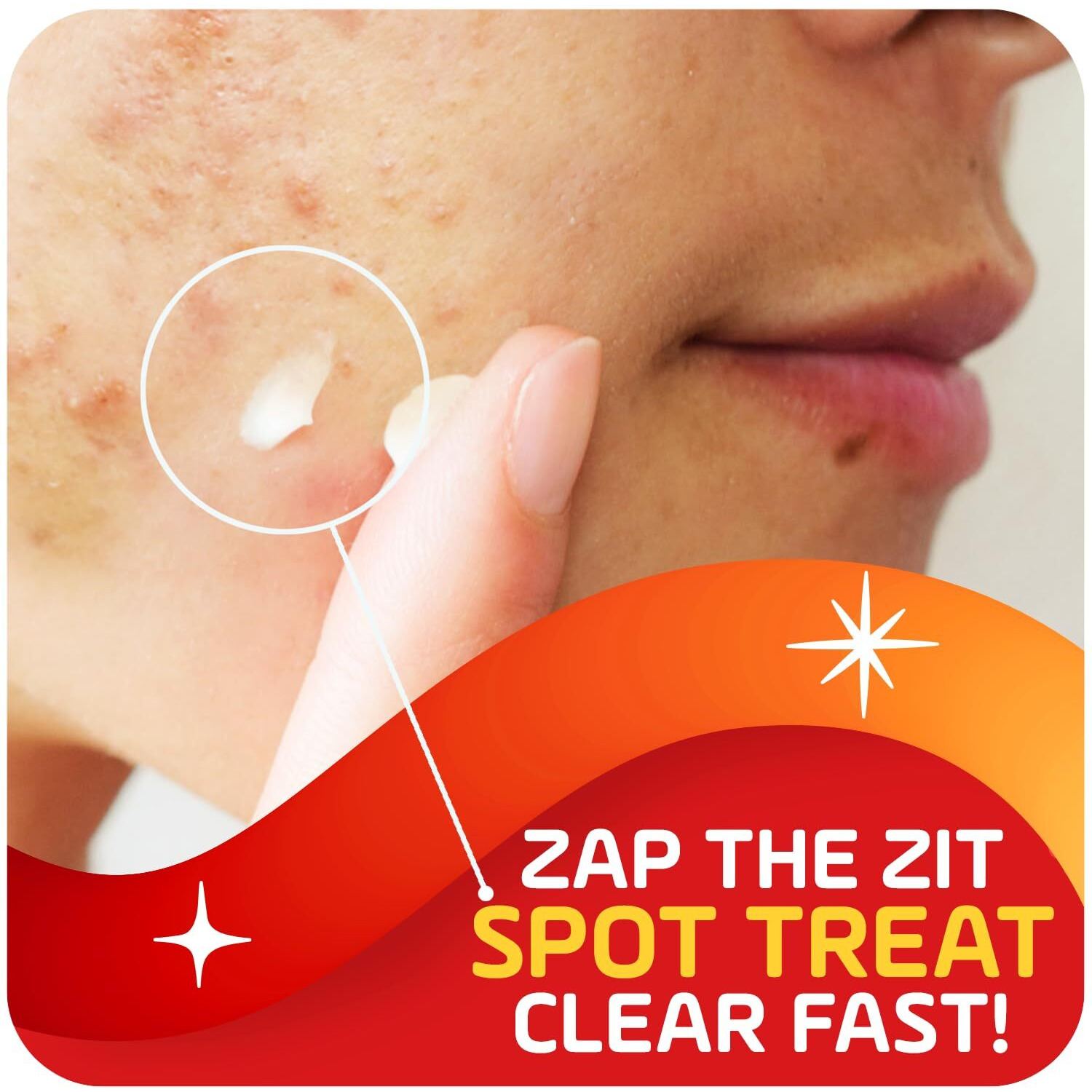 Asepxia Acne Treatment Cream For Face, 2% Salicylic Acid, Rapid Maximum Strength Acne Treatment, Clears Pimples And Blackheads, Prevents New Acne And Controls Excess Oil, 1 Oz (Pack Of 3)