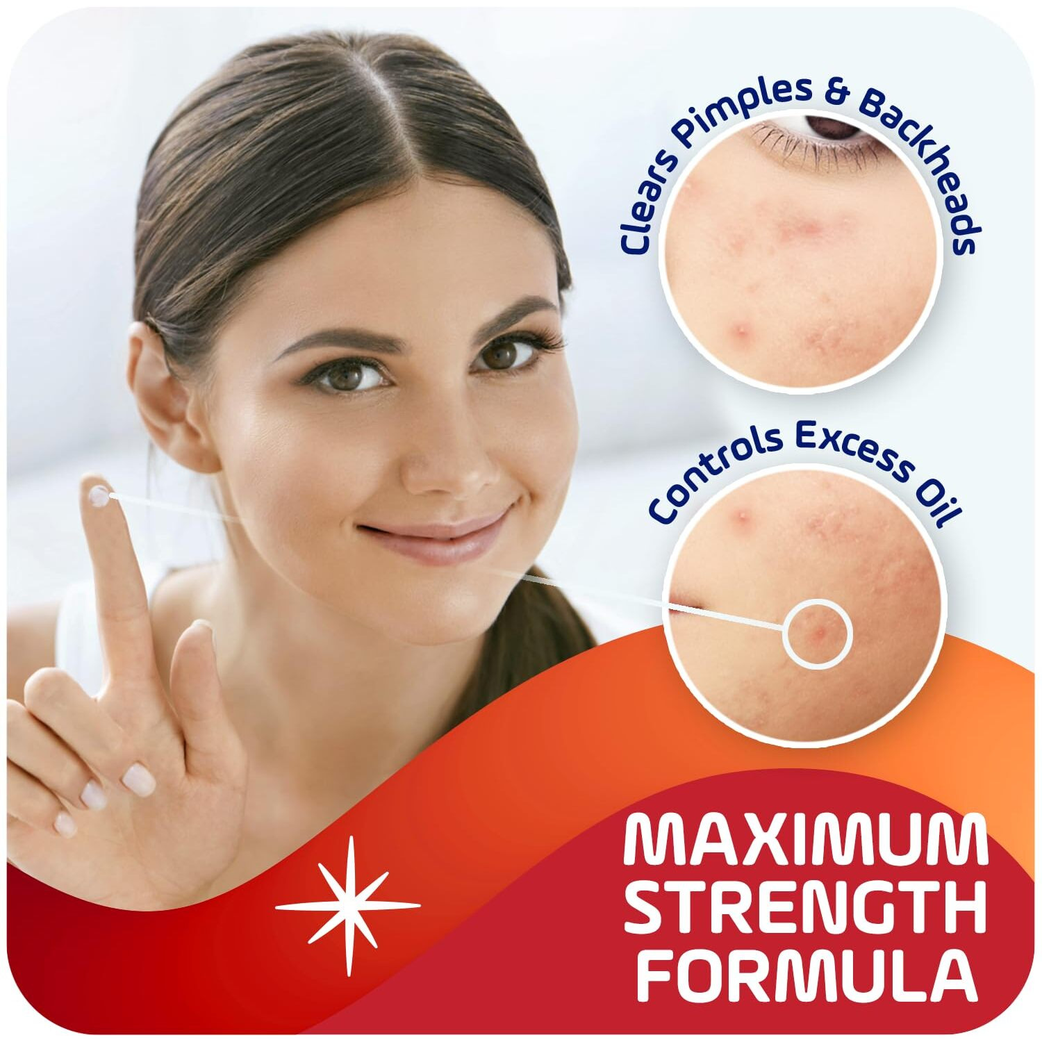 Asepxia Acne Treatment Cream For Face, 2% Salicylic Acid, Rapid Maximum Strength Acne Treatment, Clears Pimples And Blackheads, Prevents New Acne And Controls Excess Oil, 1 Oz (Pack Of 3)