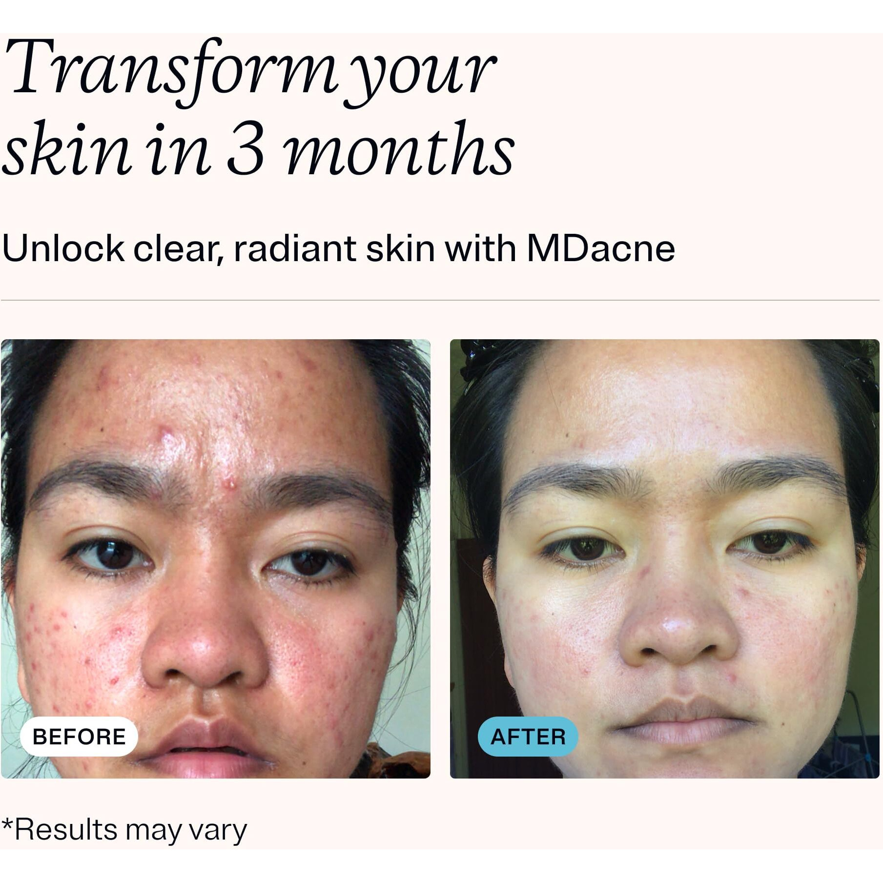 Mdacne 3 Step Benzoyl Peroxide Acne Treatment Kit - Benzoyl Peroxide Cream 2.5%, Salicylic Acid Cleanser, Niacinamide Moisturizer - Medicated Plant-Based Kit For Adult & Teen Acne, 30 Day Acne Kit