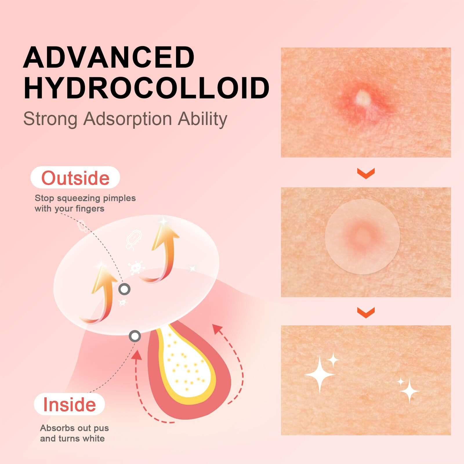 Avjone Pimple Patches For Face(144 Patches), Hydrocolloid Acne Patches With Tea Tree Oil, Pimple Stickers For Breakouts, Absorbs Zit, Invisible Spot Cover And Blemish