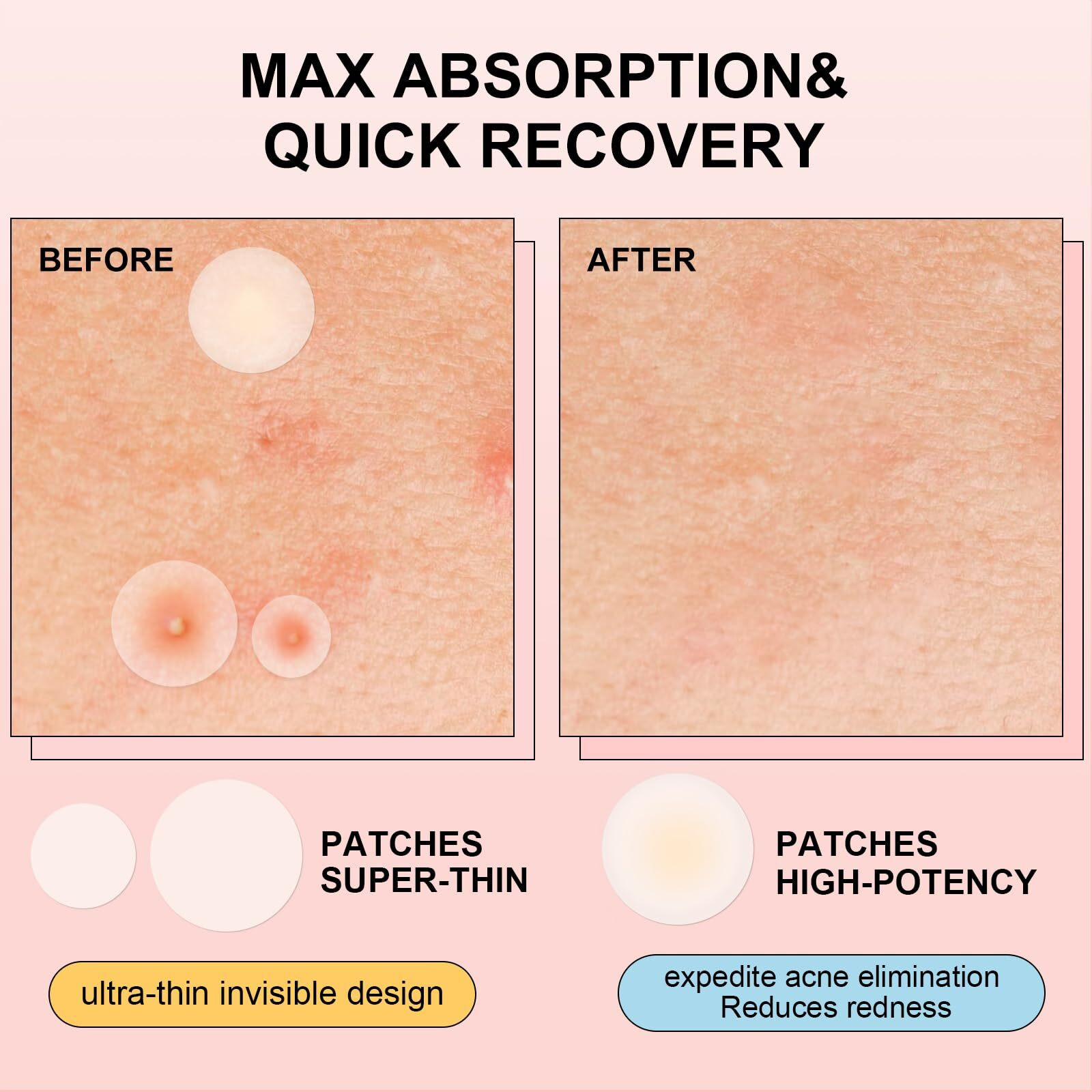 Avjone Pimple Patches For Face(144 Patches), Hydrocolloid Acne Patches With Tea Tree Oil, Pimple Stickers For Breakouts, Absorbs Zit, Invisible Spot Cover And Blemish