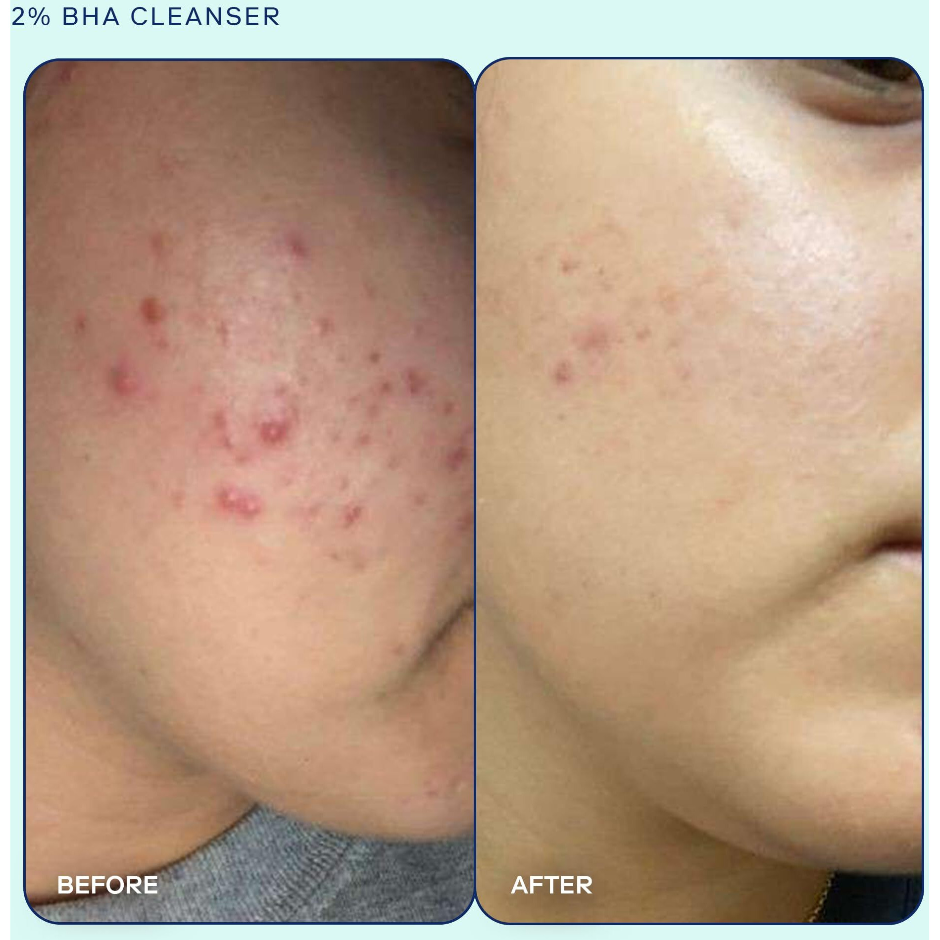 Skinfix Acne+ Bha Cleanser Multi-Level Pore Resurfacing, Deep Pore & Acne-Fighting Cleanser Helps Reduce Blemish Size, Redness & Excess Oil, 1 Fl Oz