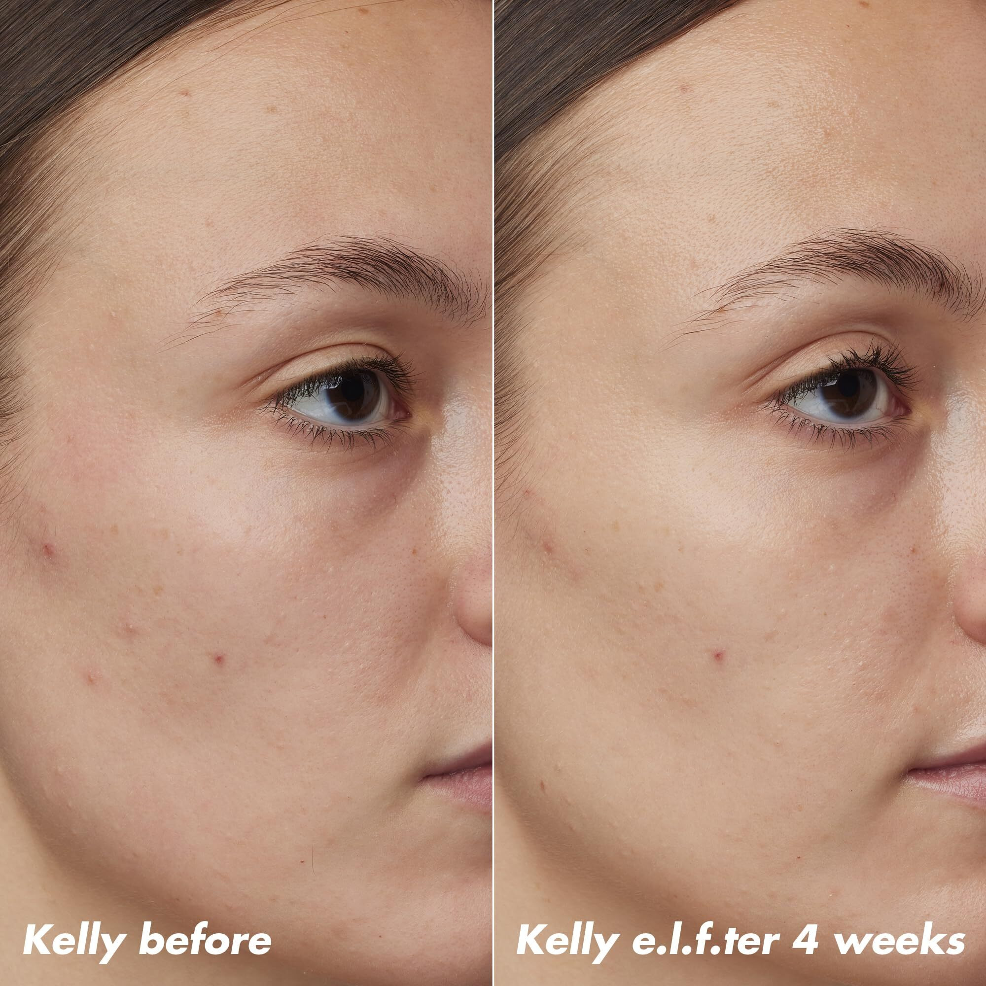 E.L.F. Skin Plz Clarify Facial Oil, Face Oil For Treating & Preventing Acne, Helps Calm Redness, Made With Salicylic Acid, Vegan & Cruelty-Free, 1 Oz