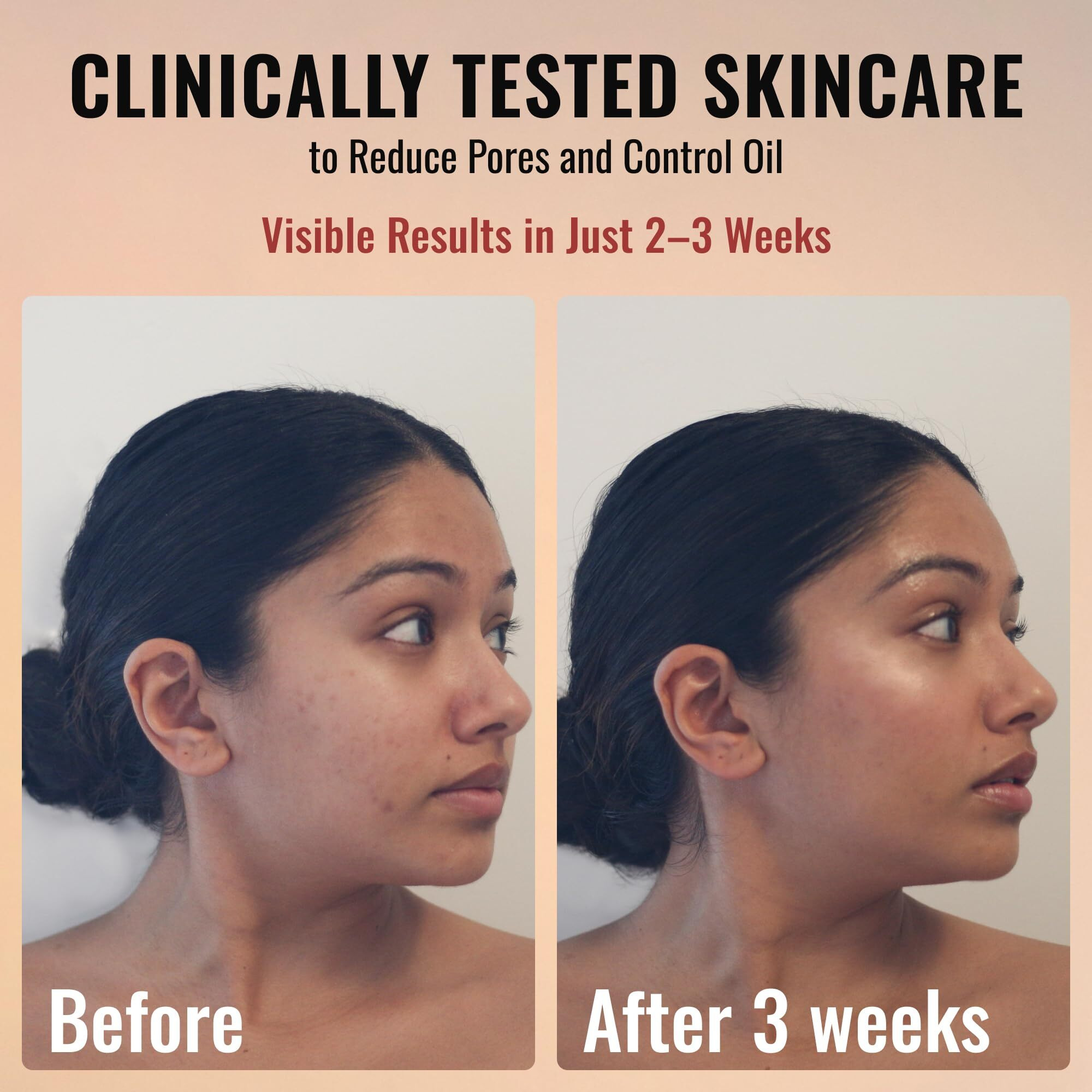 Adm Anti Aging Pure Retinol Serum For Face With Niacinamide - Resurfacing, Smoothing Fine Lines, Wrinkles, Acne Scars - Moisturizing Facial Skincare Treatment For Sensitive Skin - 1Oz