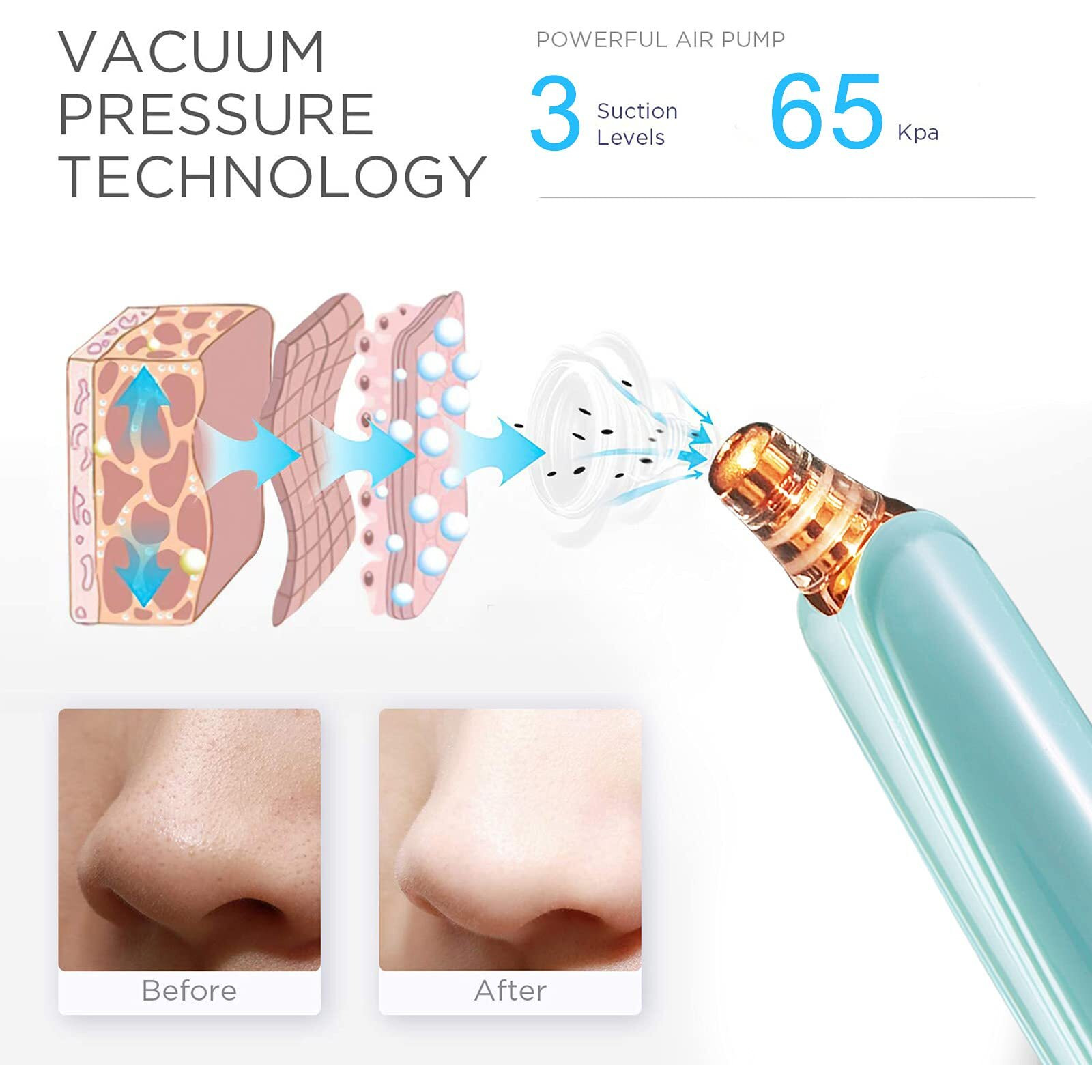 Blackhead Remover Pore Vacuum Cleaner - Upgraded Facial Pore Cleaner - Electric Usb Pore Vacuum With 5 Probes - Upgraded Blackhead Suction Tool - Blackhead Remover Kit