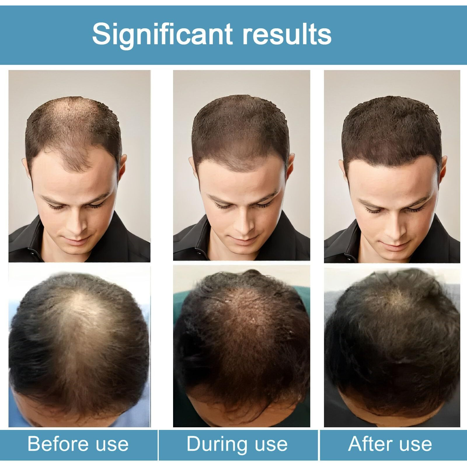 Alphainfuse Hair Regrowth System, Advanced Hair Growth Treatment Ginseng, Eclipta Prostrata, Peppermint Oil And Ginger Root, Treatment For Thicker, Strengthens Roots,For Men And Women 1Pcs