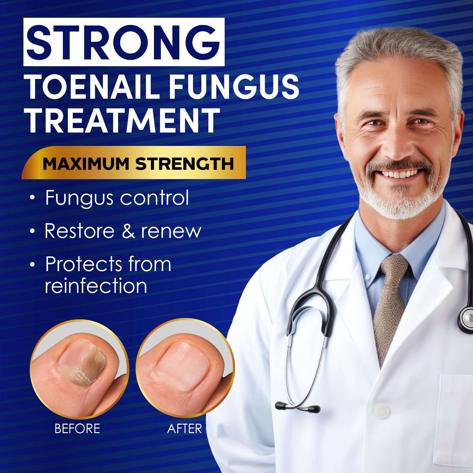 Toenail Fungus Treatment Extra Strength - Nail & Toe Solution With Undecylenic Acid 25% And Tea Tree Oil