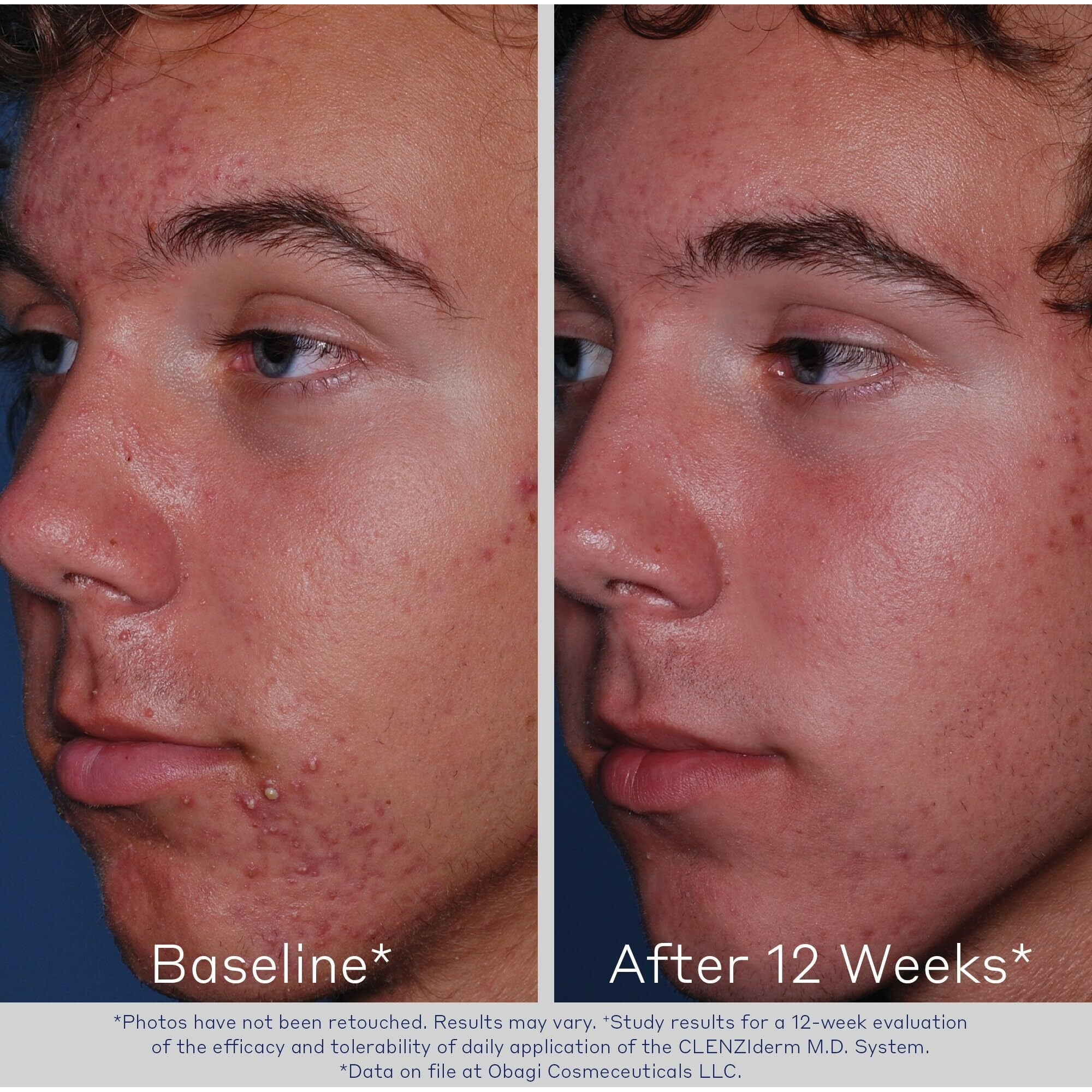 Obagi Clenziderm M.D. Daily Care Foaming Cleanser by Obagi for Women - 4 oz Cleanser