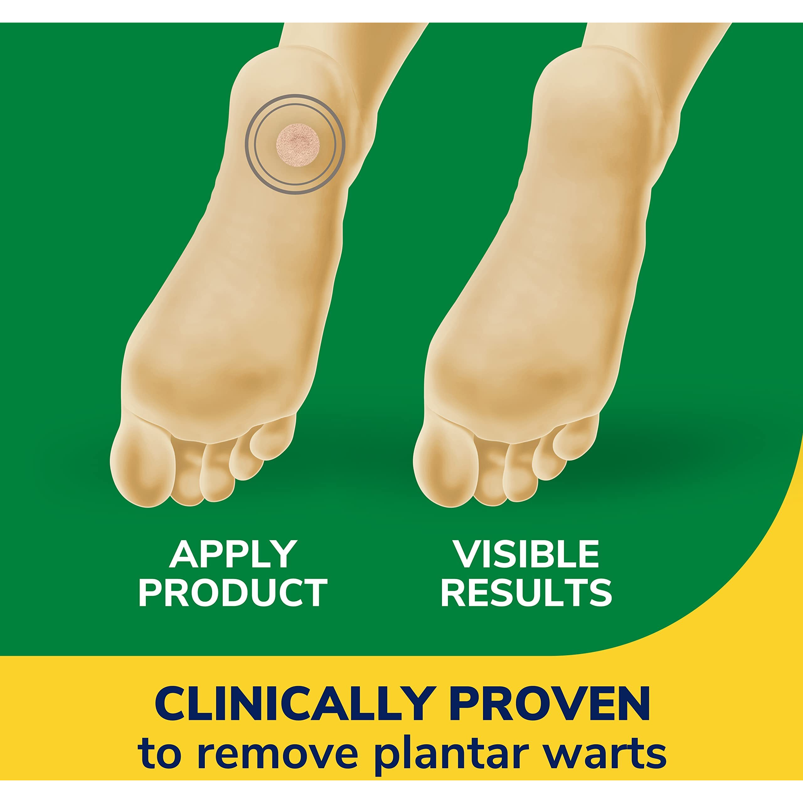 Dr Scholl's Clear Away Plantar WART Remover // 24 Discs/24 Cushions, Clinically Proven, Maximum Strength Without a Prescription, Cushioning Pad Relieves Pain, 24 Treatments