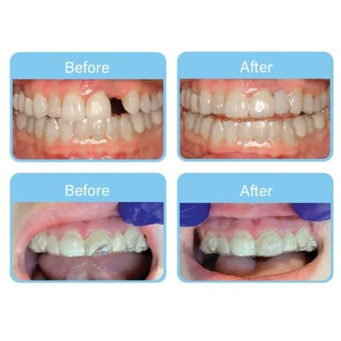 Aligner Pontics | Temporary Tooth Replacement For Aligner Trays And Retainers During Orthodontic Treatment (32 Count)