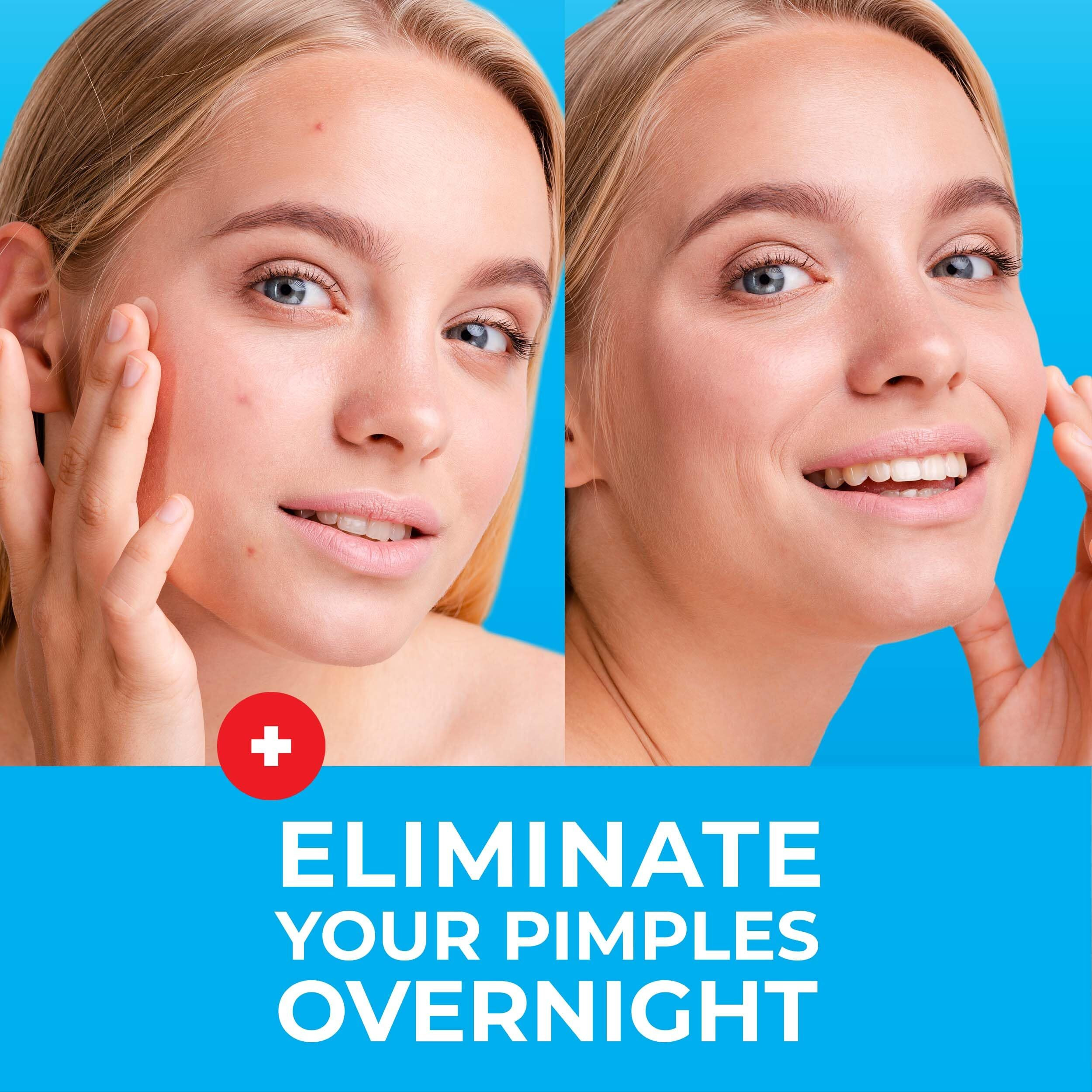 Keyconcepts Pimple Patches For Face (120 Patches)  Hydrocolloid Acne Patches With Tea Tree Oil  Pimple Patch Pimple Stickers - Hydrocolloid Patch Acne Dots - Acne Pimple Patches For Face - Zit Patches