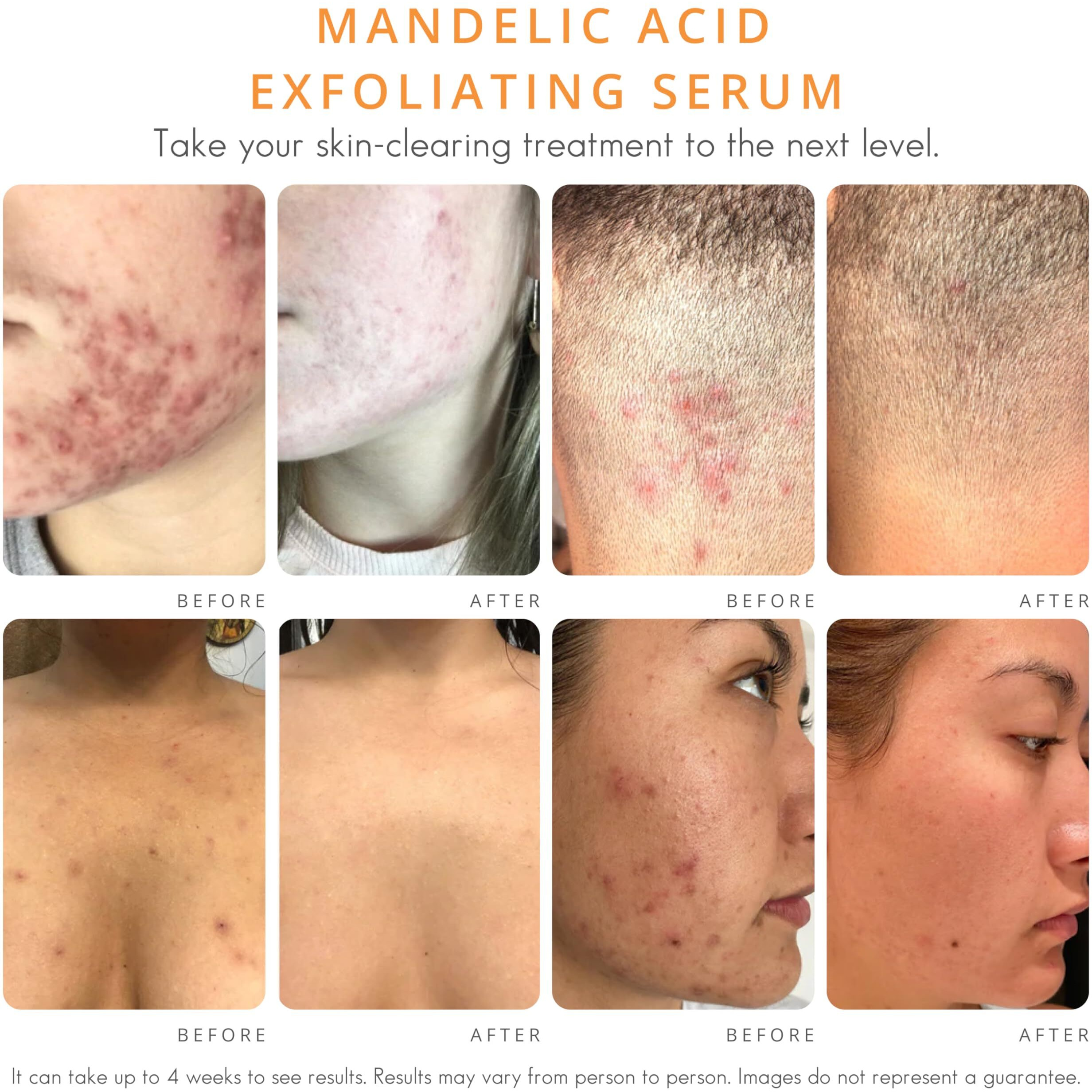 Face & Body Clearing Serum  Level 1- For Acne  Folliculitis  Aging Skin  Ingrown Hairs  Dark Spots - Face  Chest  Butt  Back  Thighs  Arms - Mandelic Acid - 1 Fl Oz