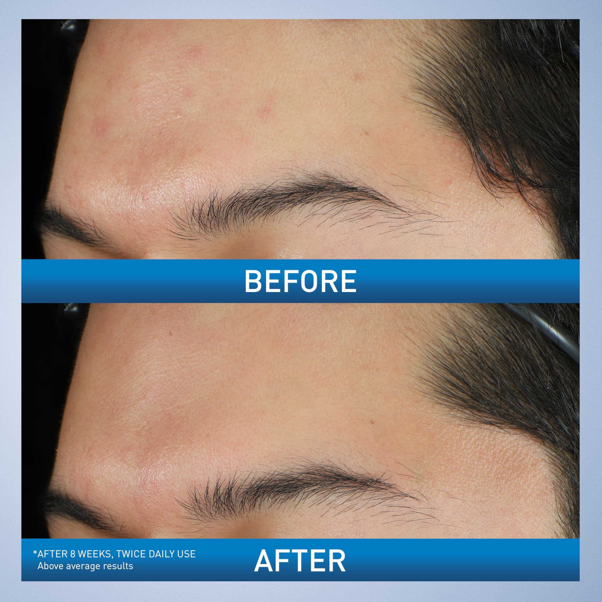 Cerave Acne Foaming Cream Wash | Gentle Face And Body Acne Cleanser With Benzoyl Peroxide 10%  Hyaluronic Acid  And Niacinamide | Acne Treatment Clears Pimples  Blackheads  Chest And Back Acne | 5 Oz