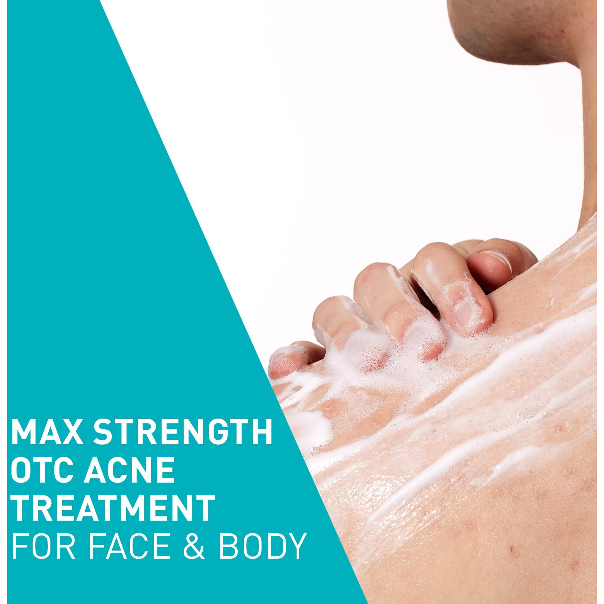 Cerave Acne Foaming Cream Wash | Gentle Face And Body Acne Cleanser With Benzoyl Peroxide 10%  Hyaluronic Acid  And Niacinamide | Acne Treatment Clears Pimples  Blackheads  Chest And Back Acne | 5 Oz