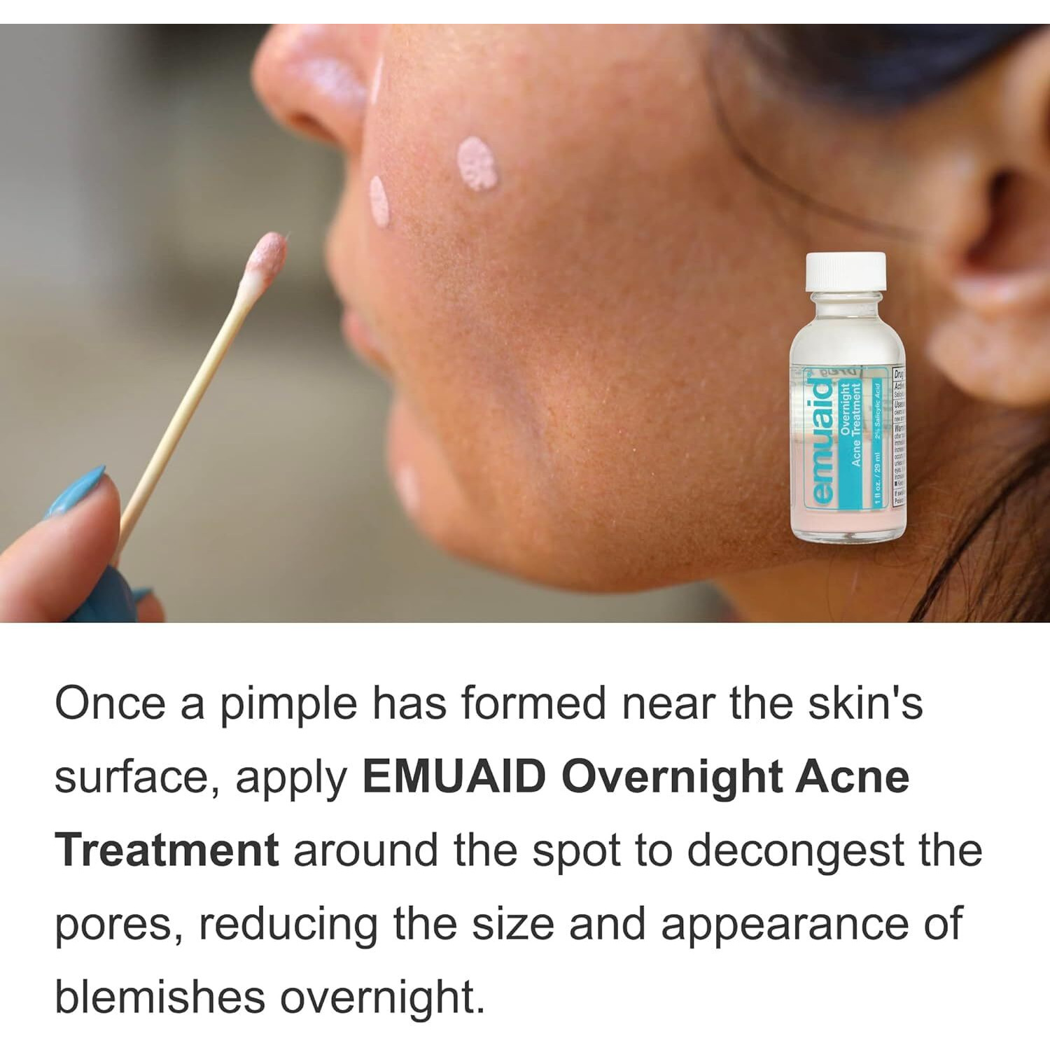 Emuaid Overnight Acne Treatment 1Oz For Stubborn Blemishes  Blackheads  Cystic Acne  And Rosacea