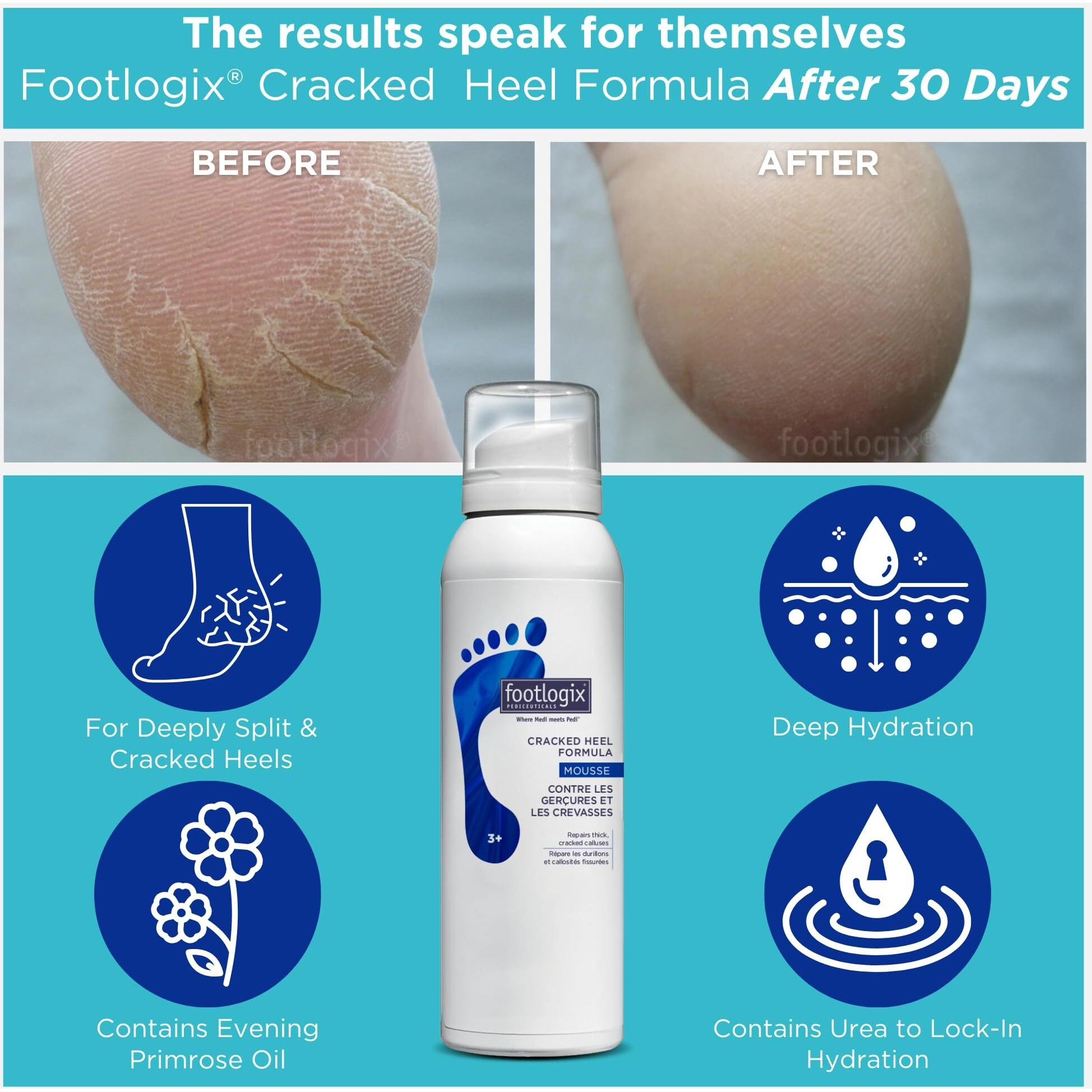 Footlogix Cracked Heel Formula  White 4.23 Ounce