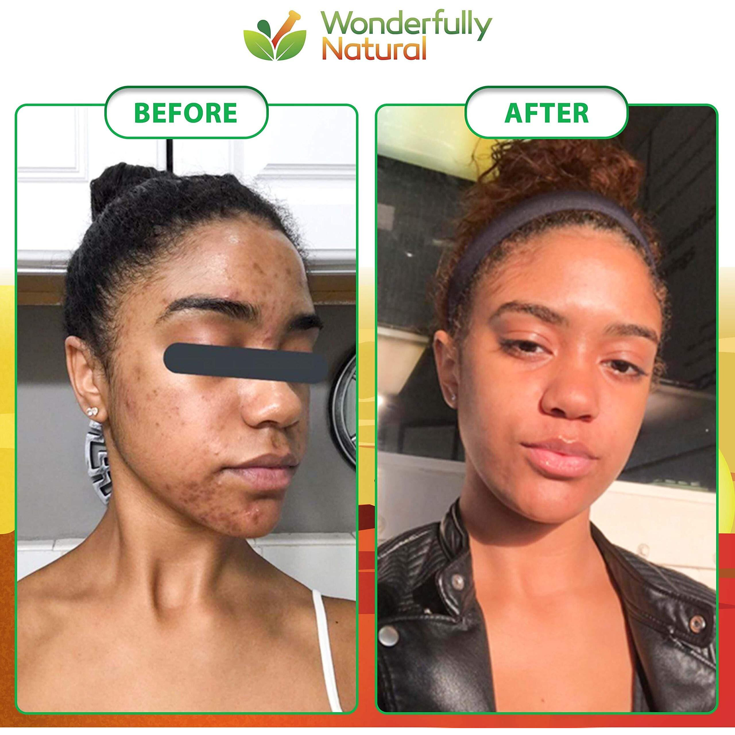 Organic African Black Soap - For Acne & Dark Spots | Natural Vegan And Cruelty Free - Satisfaction Guarantee 1Lb Bar | 90 Day Supply