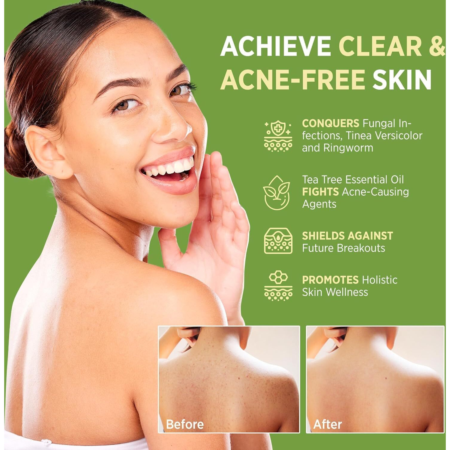 Roycederm Antifungal Antibacterial Tea Tree Soap Antifungal Antibacterial Treatment For Face & Body Acne  Athlete's Foot  Tinea  Folliculitis Ringworm Jock Itch (Pack Of 1)