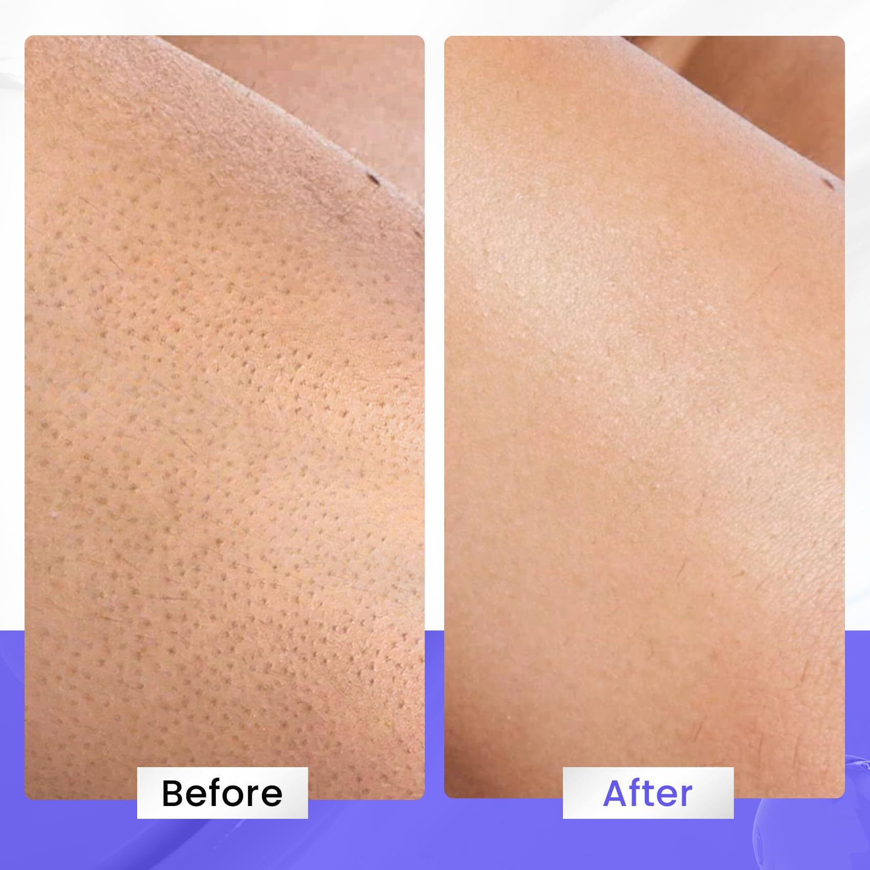 Elvira Kp Bump Eraser Body Scrub  Exfoliating Body Scrub For Keratosis Pilaris  Smooth Skin With 10% Aha Bha And Niacinamide  Moisturizing Body Skin Care Products  Deep Cleansing