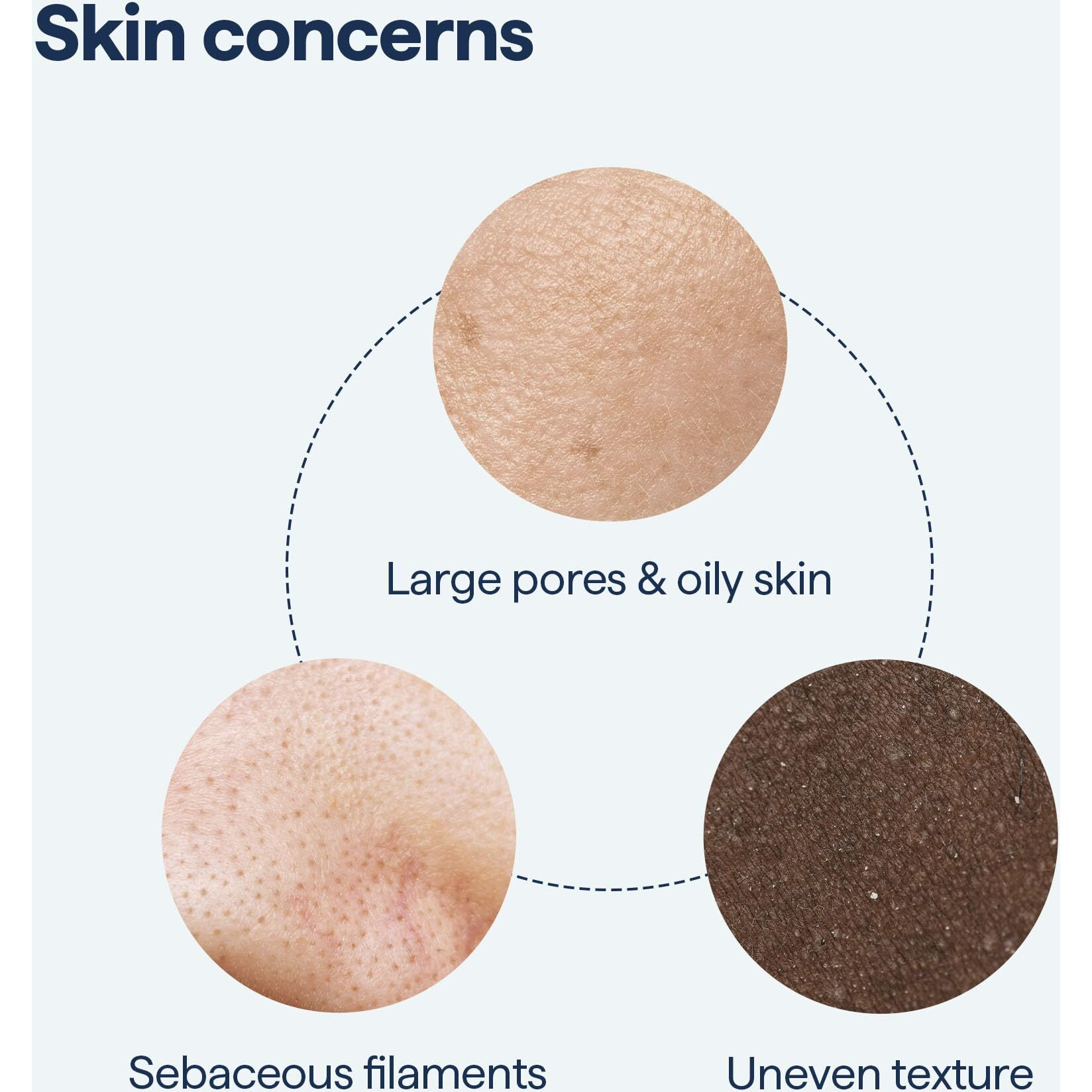 Remedy For Pore Size - Large Pore Minimizer With Retinol  Bha Salicylic Acid  Niacinamide - For Uneven Texture  Pimples  Blackheads  Whiteheads  Sebaceous Filaments - By Dermatologist Dr. Shah