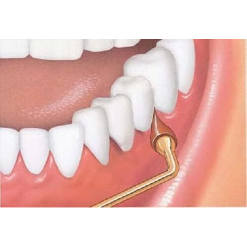 Gum Stimulator Permanent Handle - 1 Rubber Tip Included - Long Handled Massager Remove Plaque & Promote Health  1Ct (6Pk)