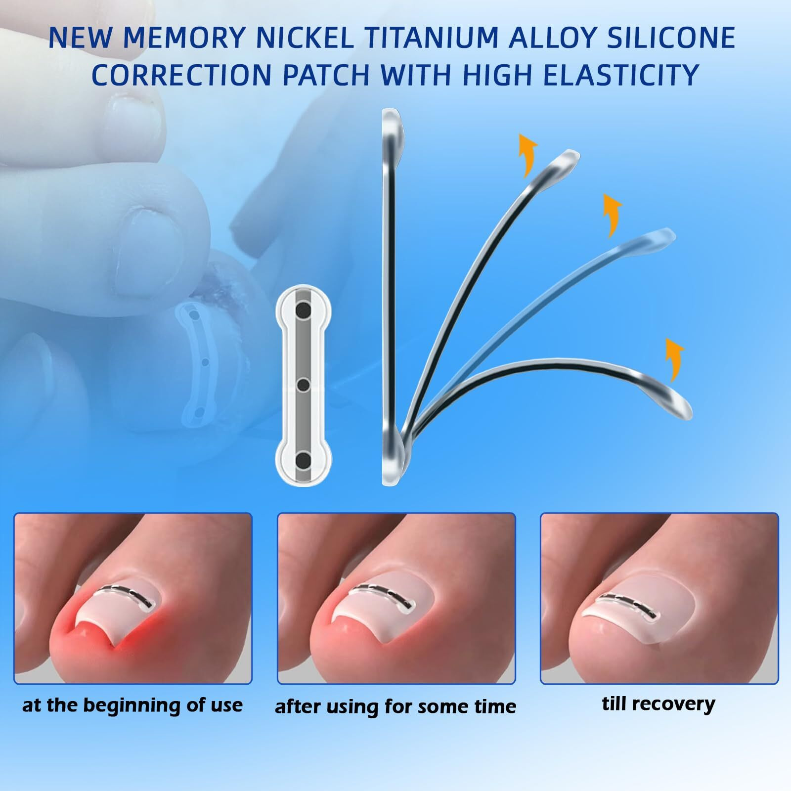 Truey Titanium Alloy Silicone Ingrown Toenail Treatment  Nail Correction Patch  Ingrown Toenail Corrector  Nail Correction Tool  Ingrown Toenail Removal Kit  Applicable For Any Toenail Size Men Woman