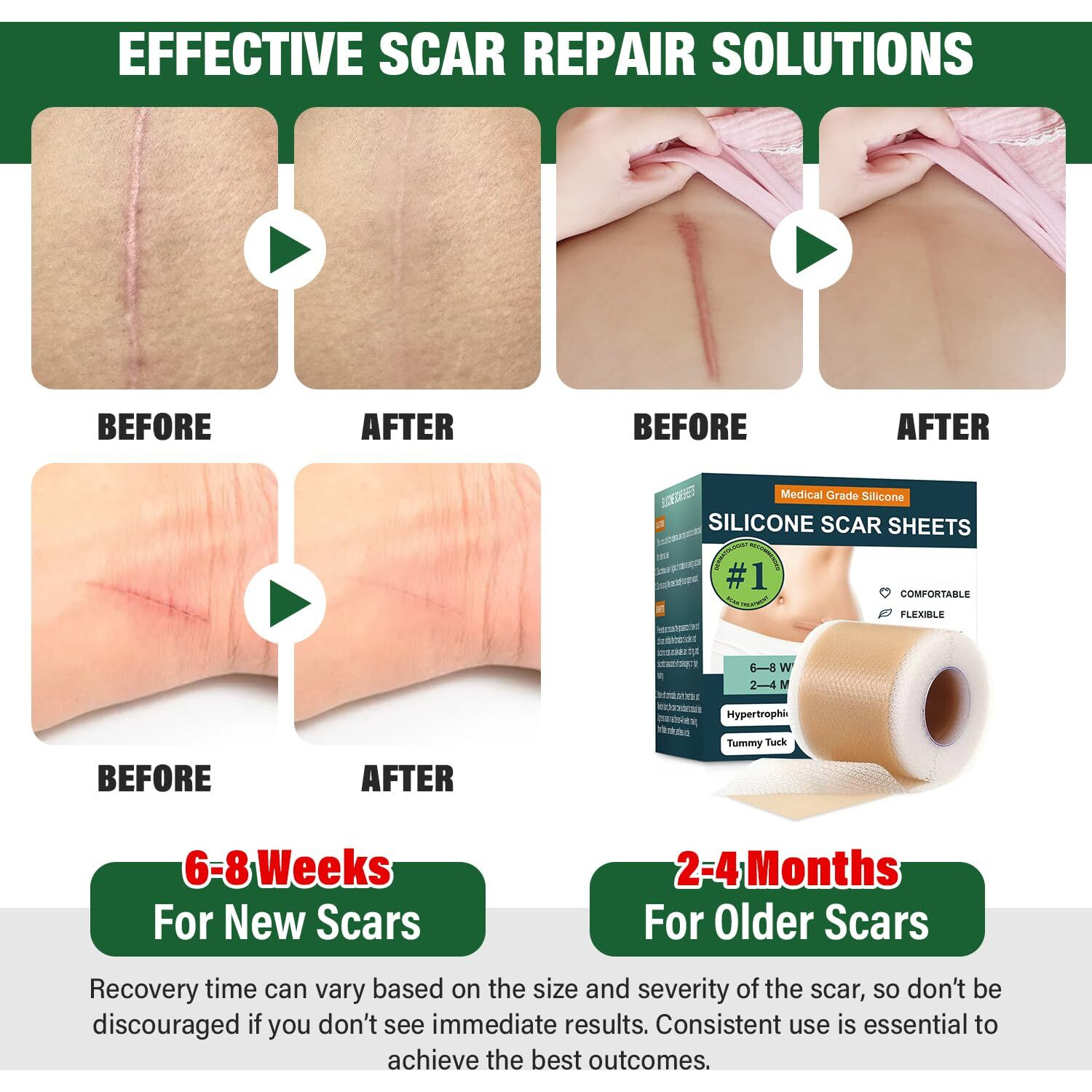 Silicone Scar Sheets Silicone Scar Tape Silicone Sheets For Scars Scar Tape For Surgical Scars Keloid Bump Removal Scar Removal For Surgical(1.6"&quotX 60"" Roll-1.5M)
