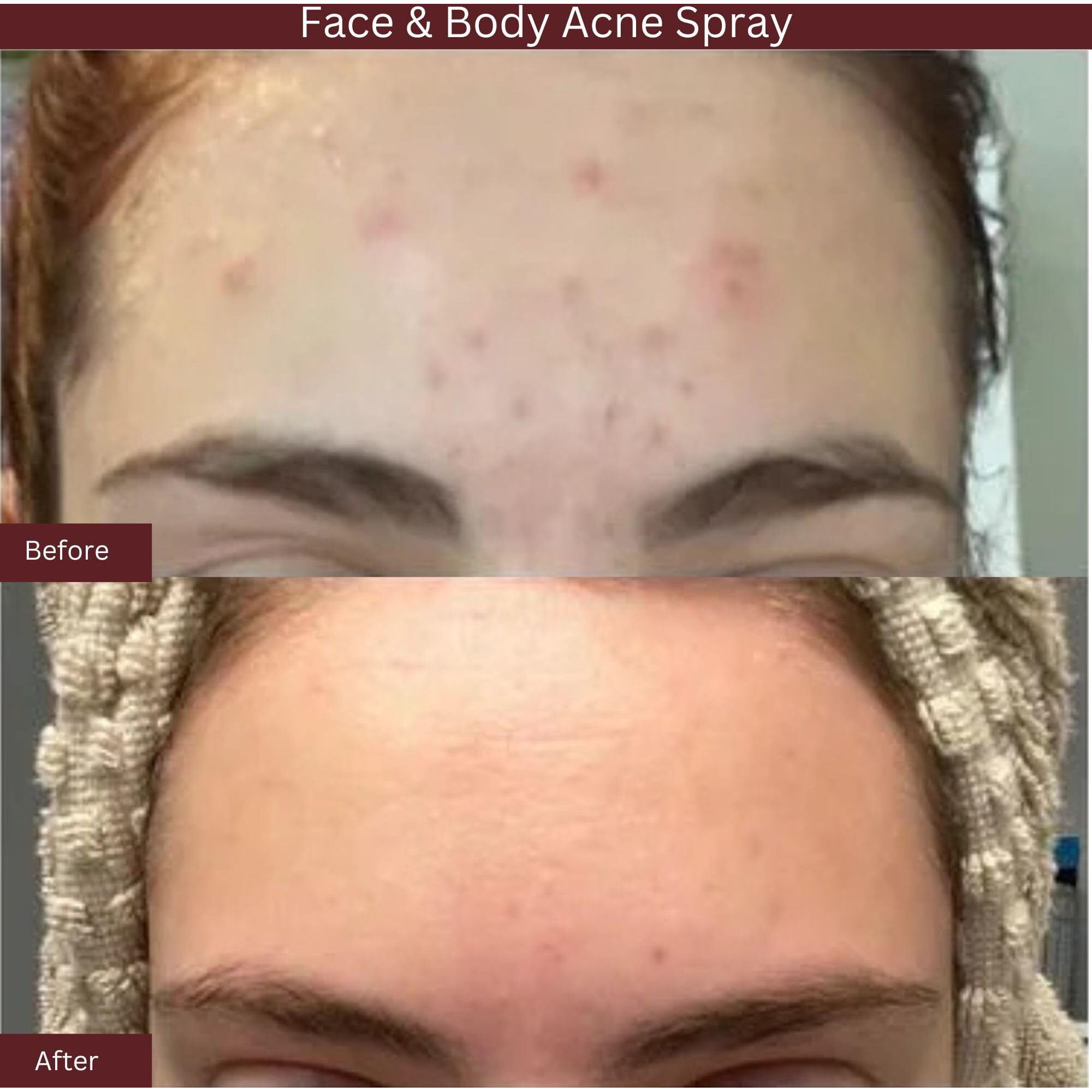 Itk Skincare Salicylic Acid Spray For Face & Body Acne - Blemish-Fighting Treatment For Body Acne  Bacne  Blackheads  Pimples & Blemishes - Bha Blemish Facial Mist Post Workout - 3.3Oz Spray Bottle