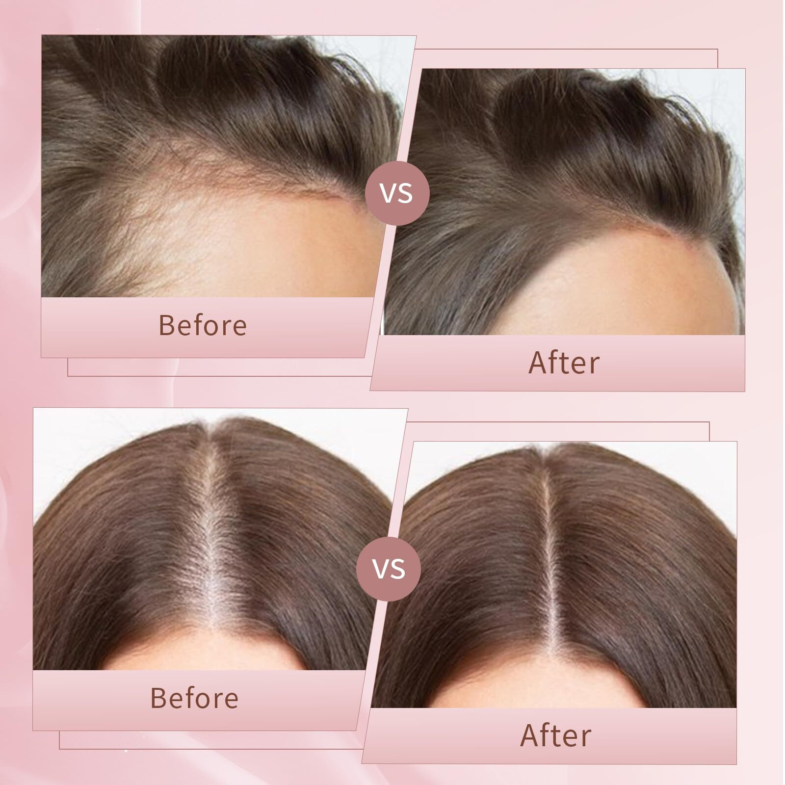 Hair Growth Serum Hair Loss Treatment For Women And Men - Gro Hair Serum For Thining Hair - Fuller Thicker And Healthier Hair  1 Fl Oz