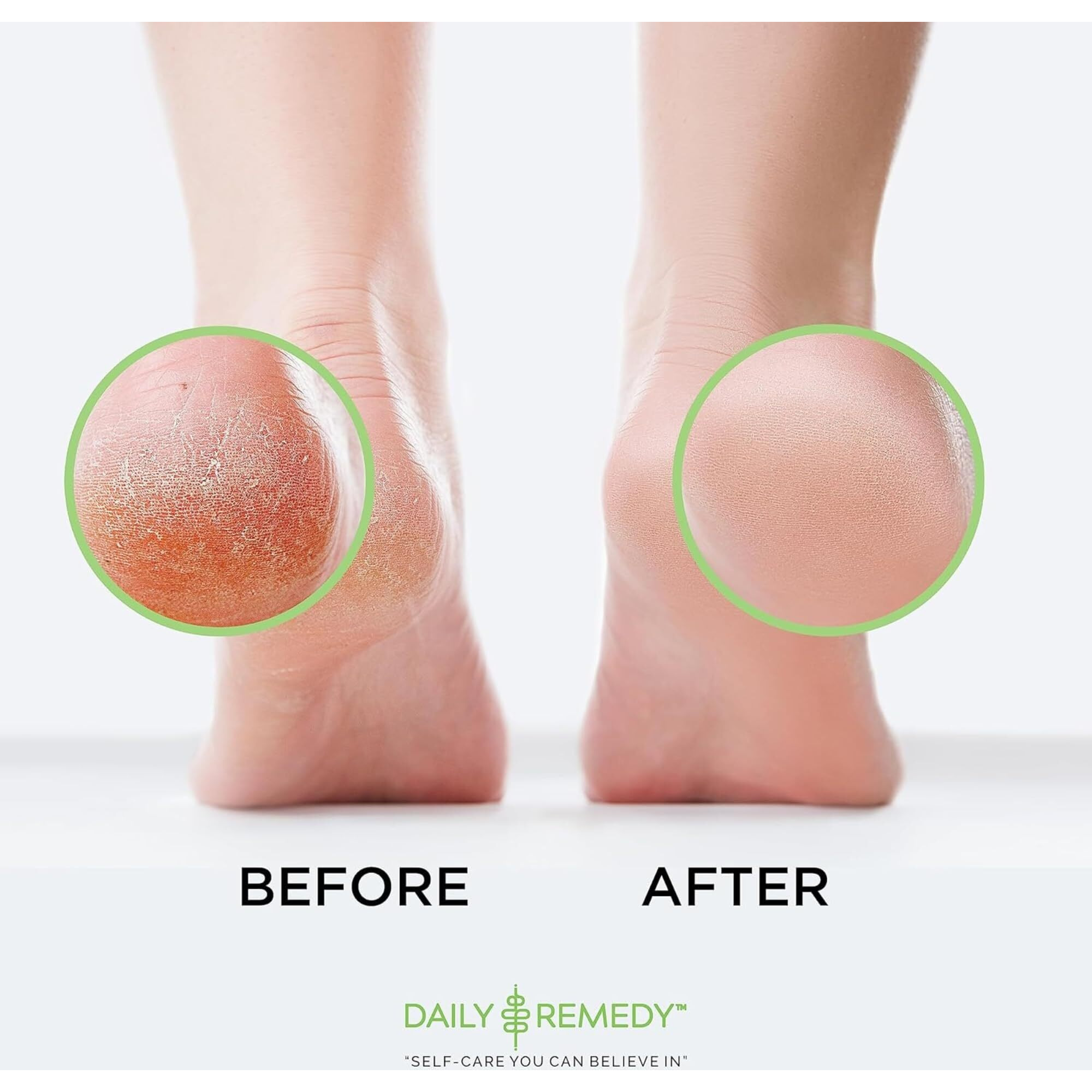 Foot Callus Remover Gel Set - Professional Callus Remover For Feet Gel - Calloused Feet Remover Gel - Feet Callus Remover For Smooth Feet & Cracked Heels - 16Oz (2 Pack X 8Oz) - Made In Usa