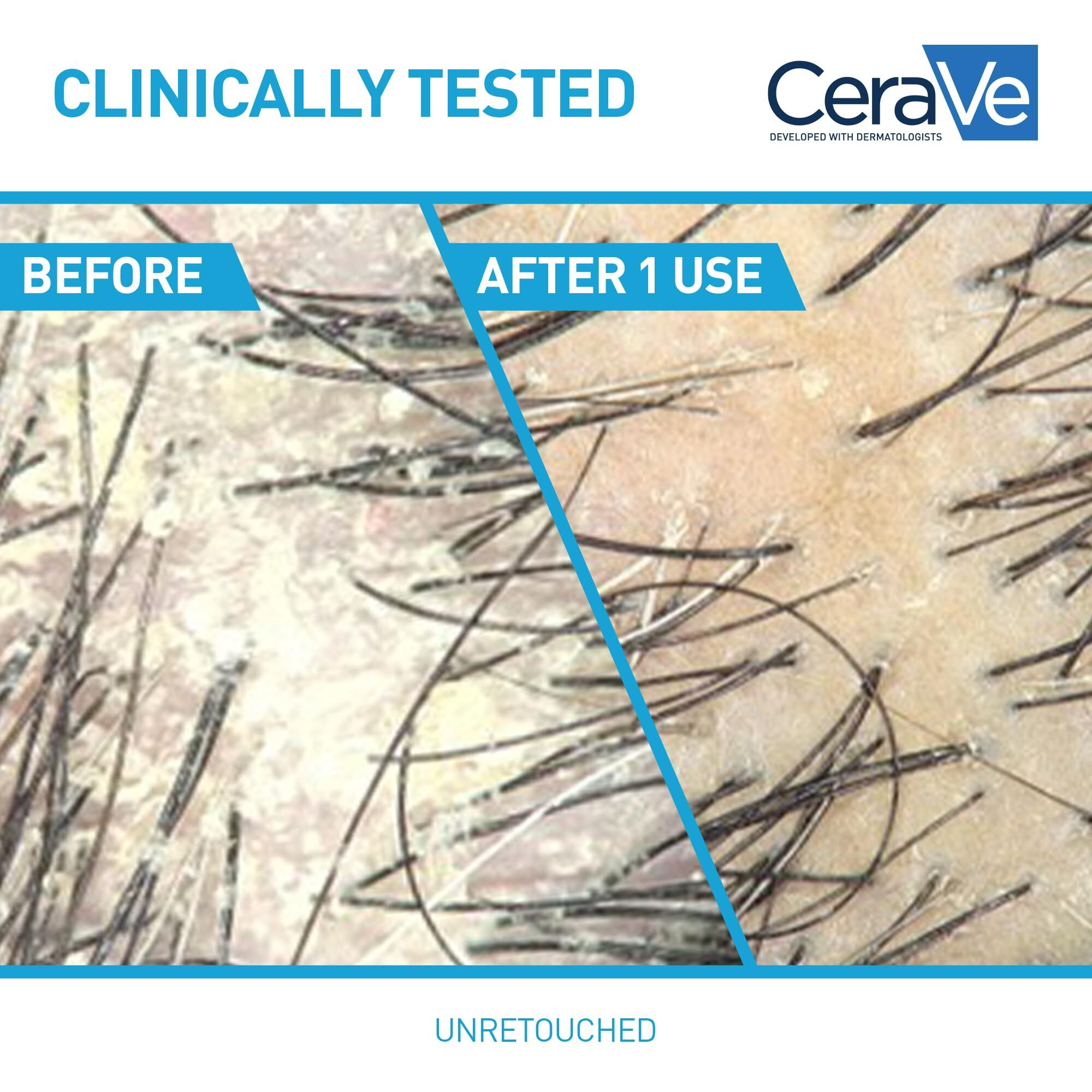 Cerave Hydrating Anti Dandruff Conditioner  0.5% Pyrithione Zinc Dandruff Treatment With Ceramides  Hyaluronic Acid & Niacinamide  Helps Eliminate Flakes & Reduce Itchy Scalp  Sulfate Free Conditioner