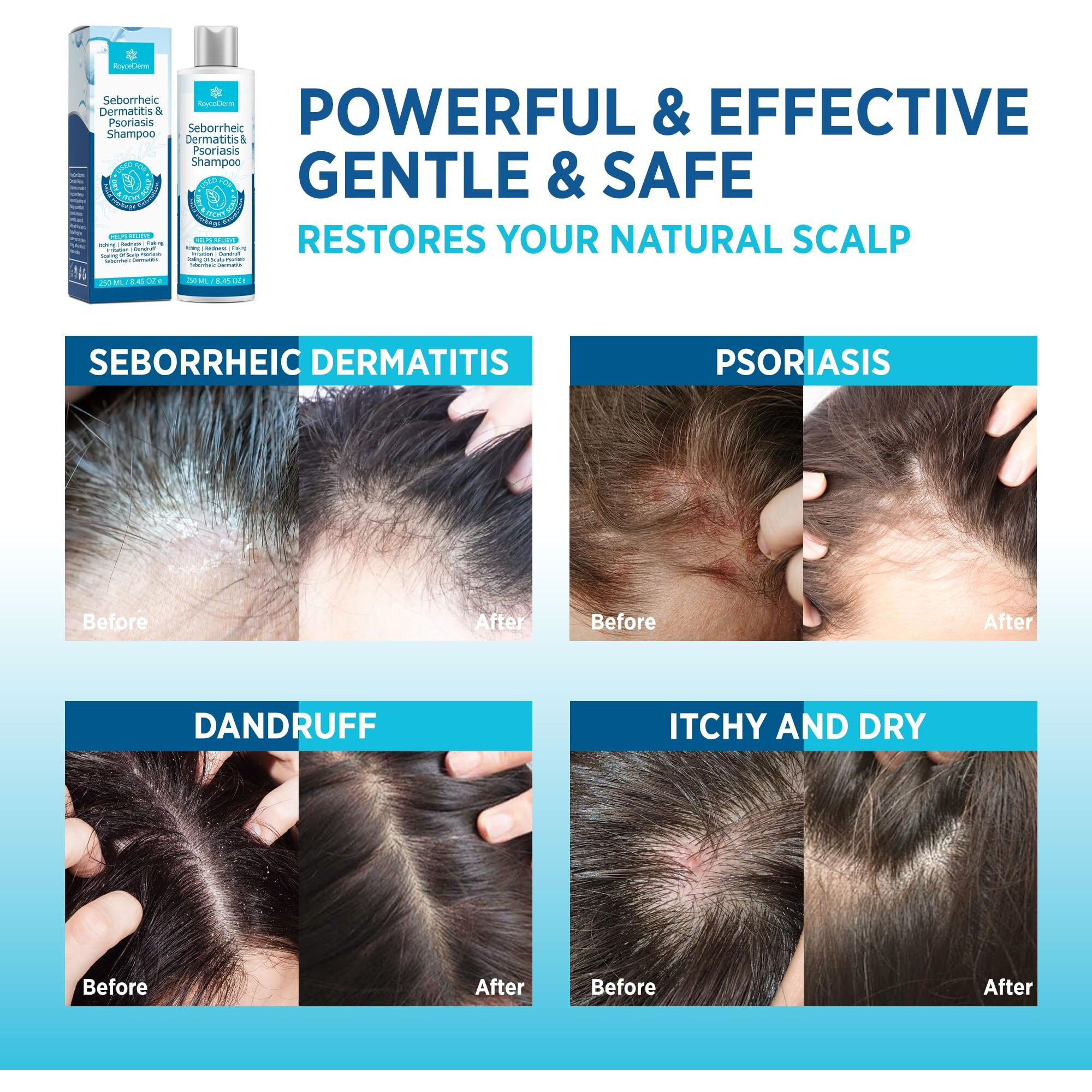 Seborrheic Dermatitis & Psoriasis Cream  Shampoo And Conditioner Set - Scalp Therapy System For Folliculitis  Psoriasis  Dandruff  Dry Scalp - Scalp Treatment To Relieve Itching  Flaking  Irritation