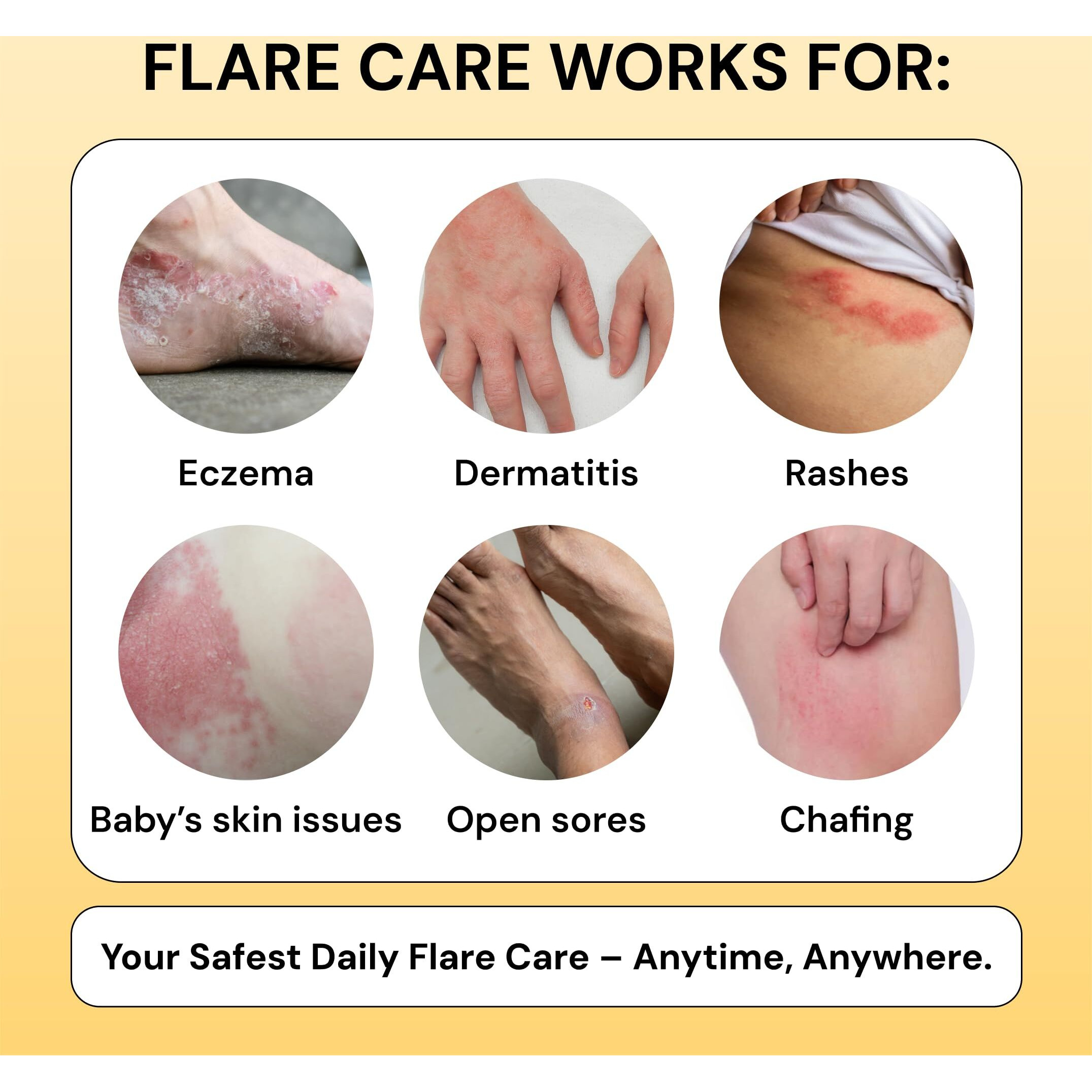 Universal Flare Care | Essential Oil Free | Relief For 100+ Skin Issues | Eczema  Dermatitis  Psoriasis  Rashes  Baby's Skin Issues  Hidradenitis  Chafing  Sores  Wounds | With Propolis & Egg Yolk 1Oz