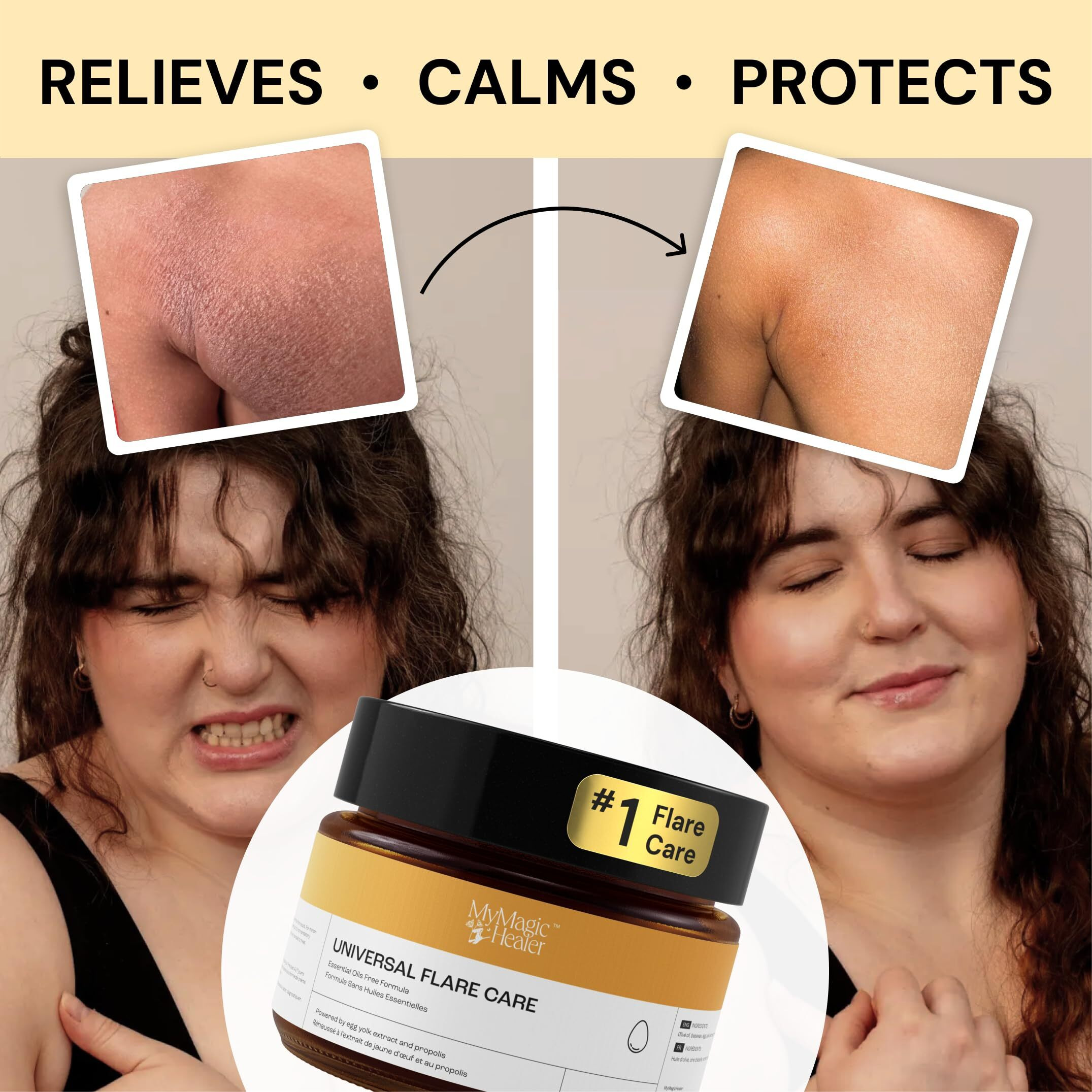 Universal Flare Care | Essential Oil Free | Relief For 100+ Skin Issues | Eczema  Dermatitis  Psoriasis  Rashes  Baby's Skin Issues  Hidradenitis  Chafing  Sores  Wounds | With Propolis & Egg Yolk 1Oz