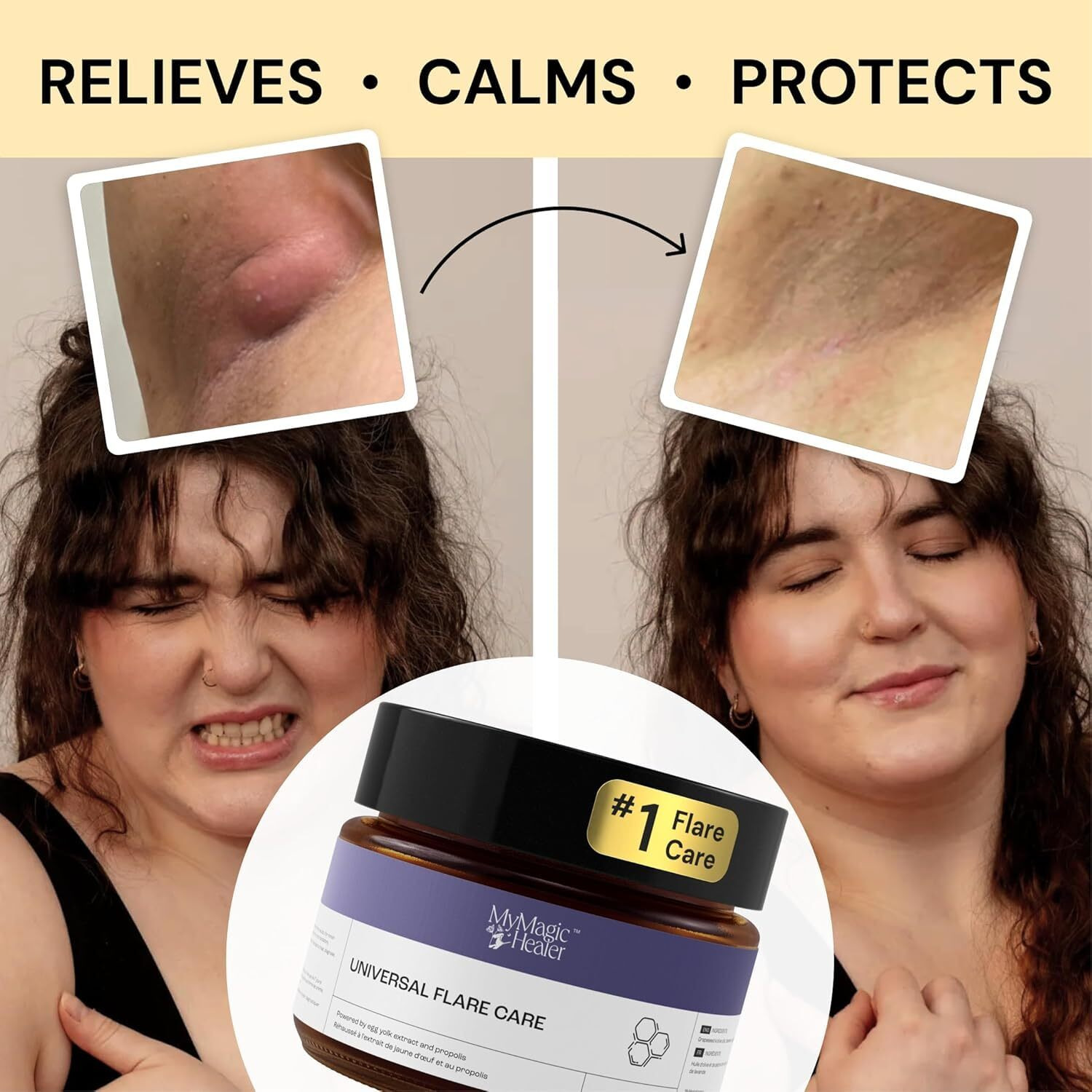 Universal Flare Care | Relief For 97% Of Skin Issues | Cysts  Inflamed Skin  Hidradenitis Suppurativa  Abscesses  Impetigo | All Natural Flare Up Solution With Propolis & Egg Yolk Extract 1 Oz